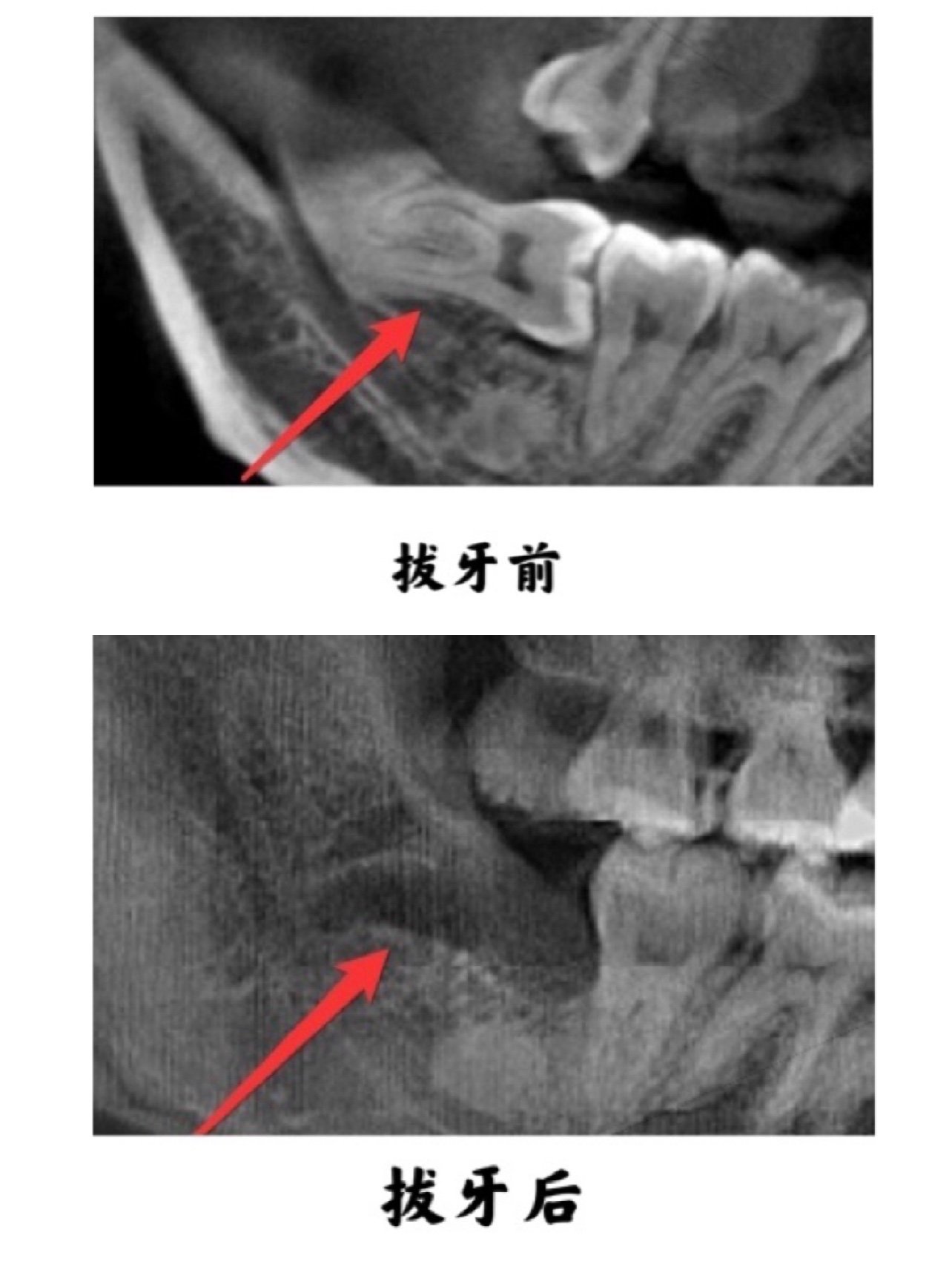 拔智齿前必须考虑的一个重要因素就是牙根的位置拔牙前必须拍片拍ct