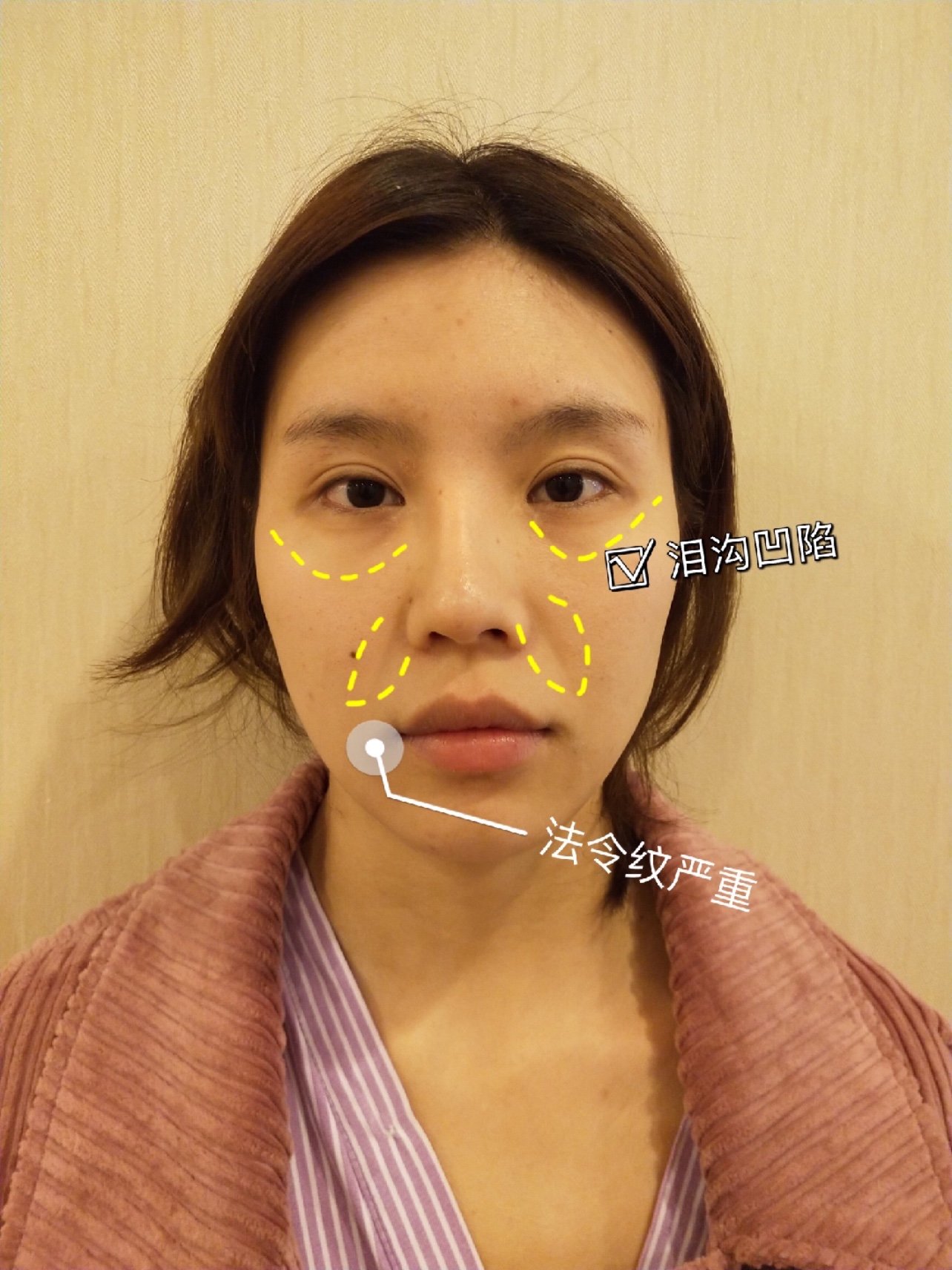 自体脂肪填充全面部 填充泪沟 苹果肌 法令纹等部位,调整整个