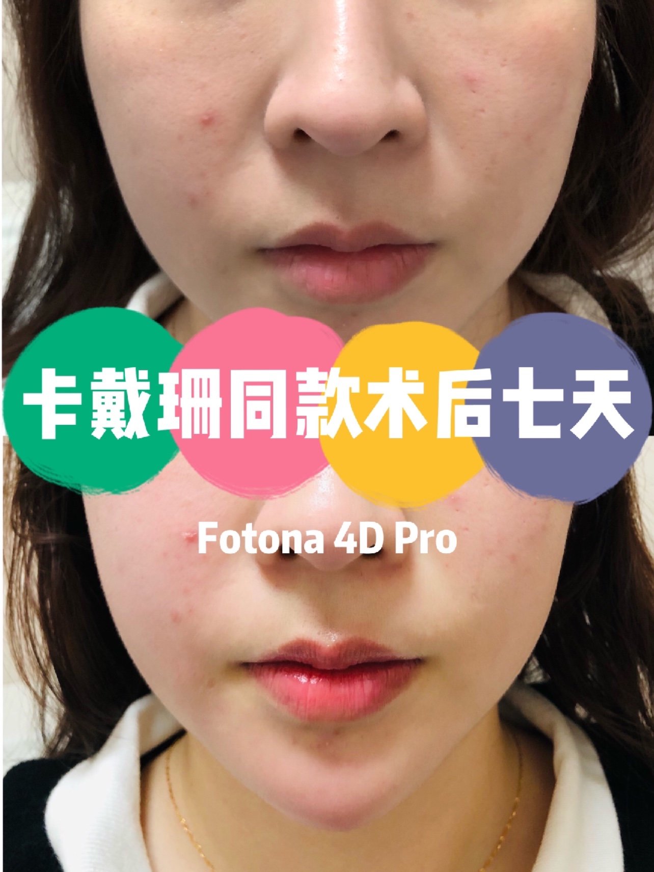 新氧体验官fotona4d