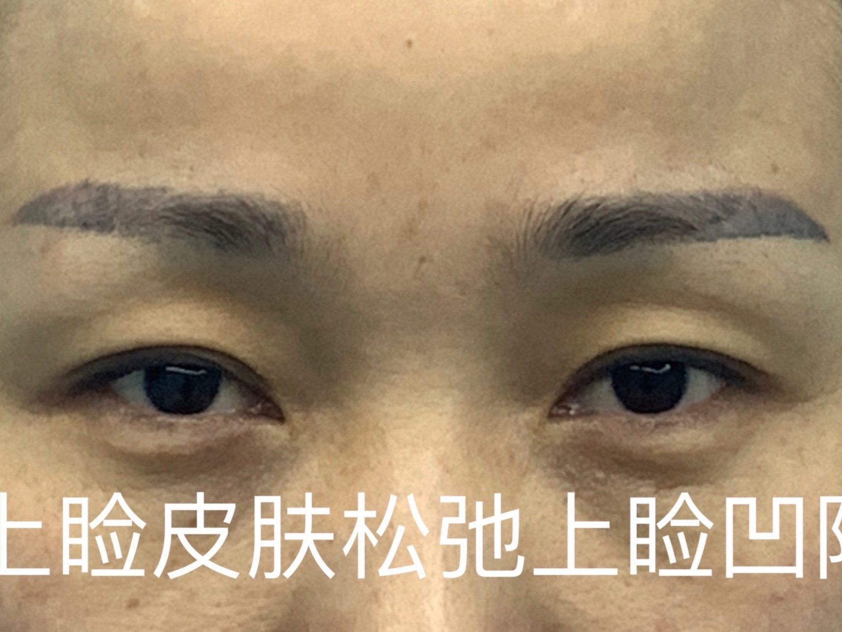 埋线后上睑皮肤松弛上睑凹陷