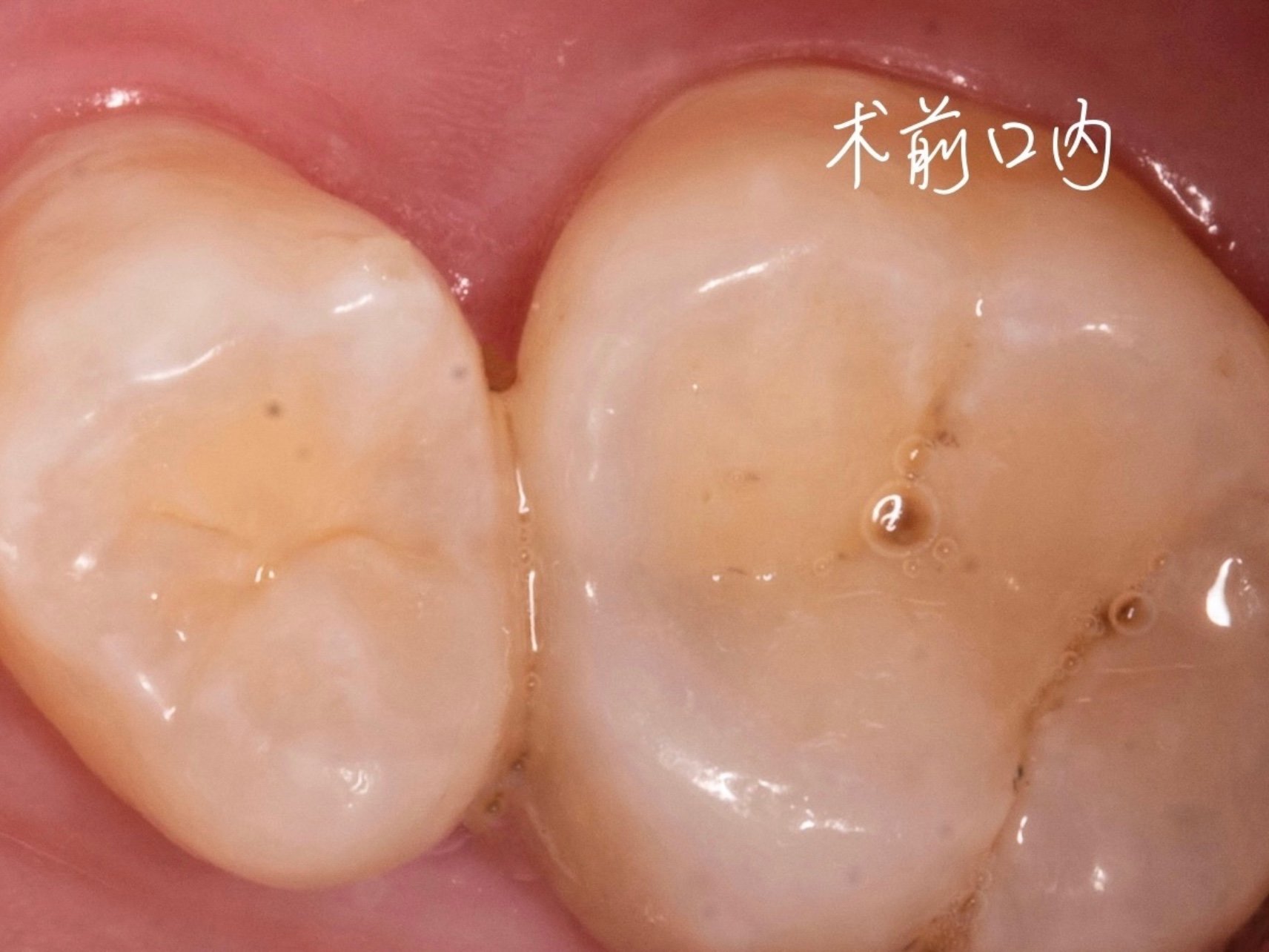 邻面龋初期龋齿比较轻微不会有疼痛不适的症状,但如果发展为牙髓炎