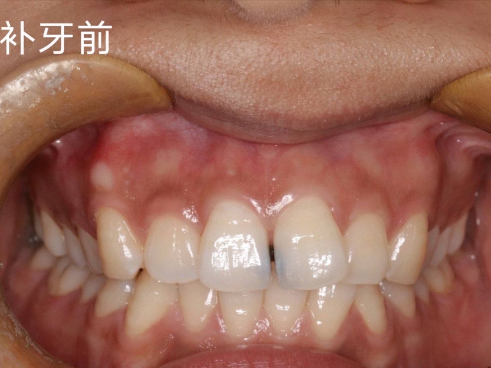 门牙龋坏发黑