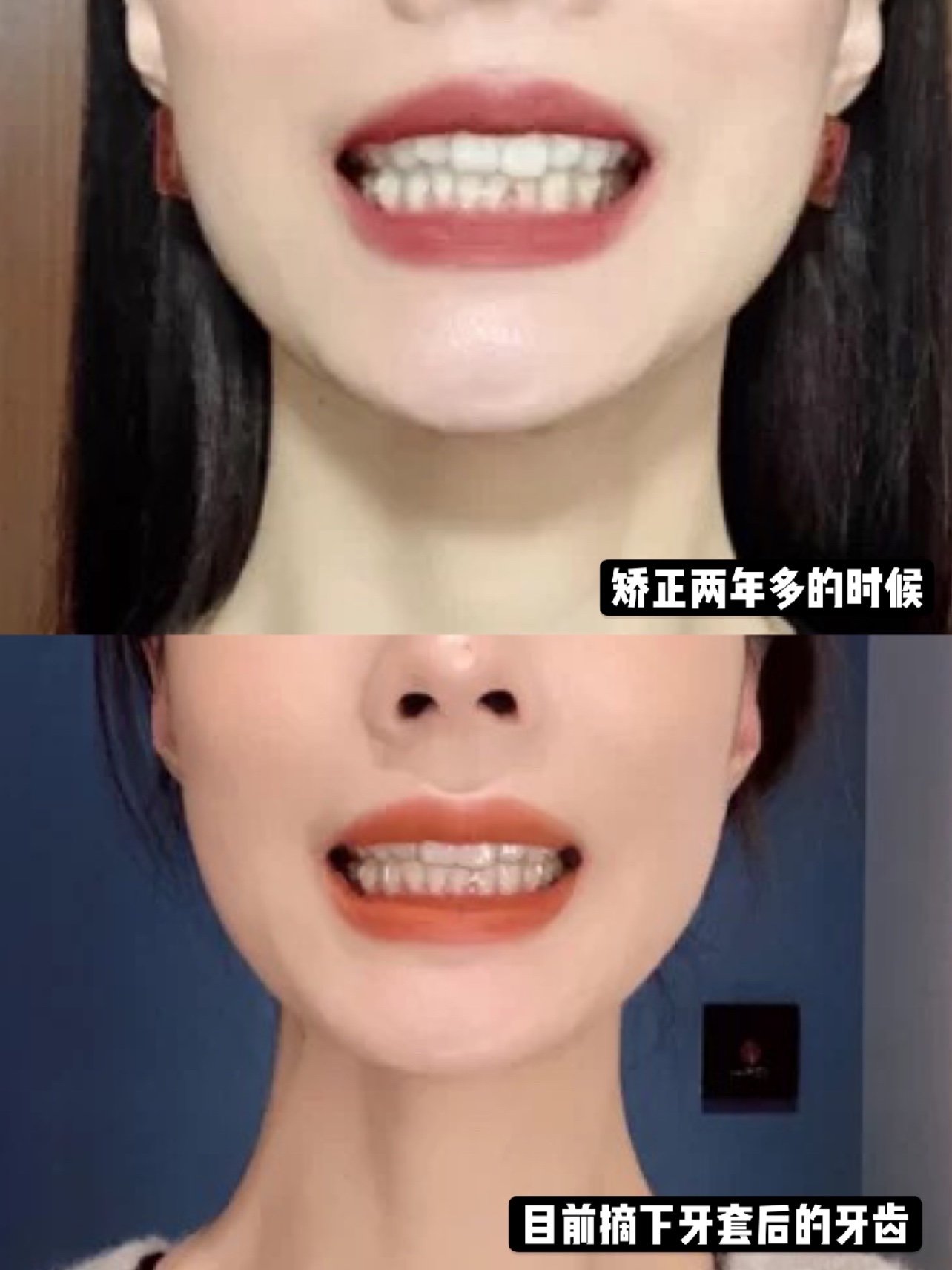 正地点:北京拜博 矫正医师:周强医生 小姐姐属于大龄正畸,牙齿的咬合