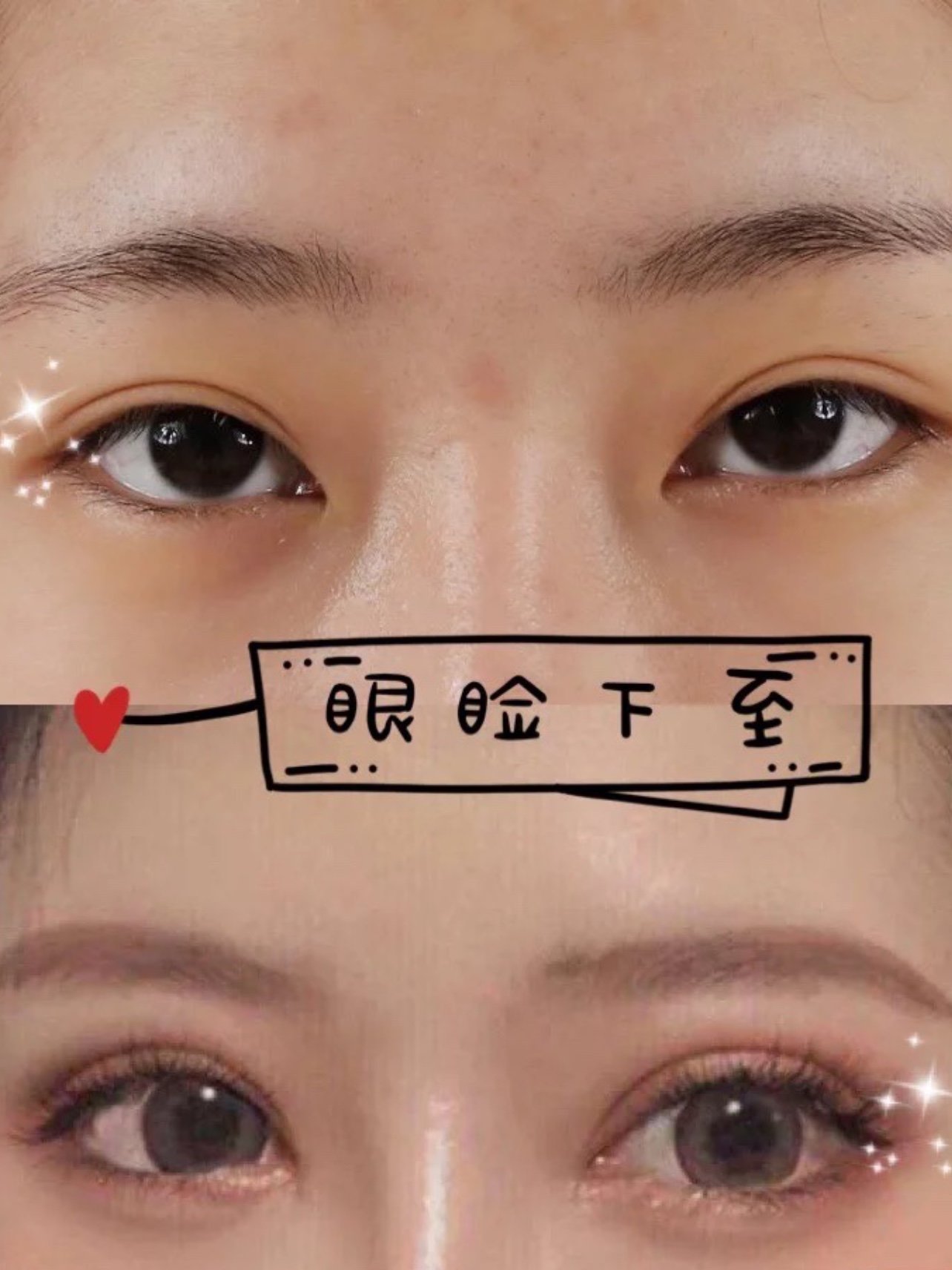 【下眼下至术】眼睑下至术 改善吊眼 切口隐蔽无外翻【纵横放大双眼】