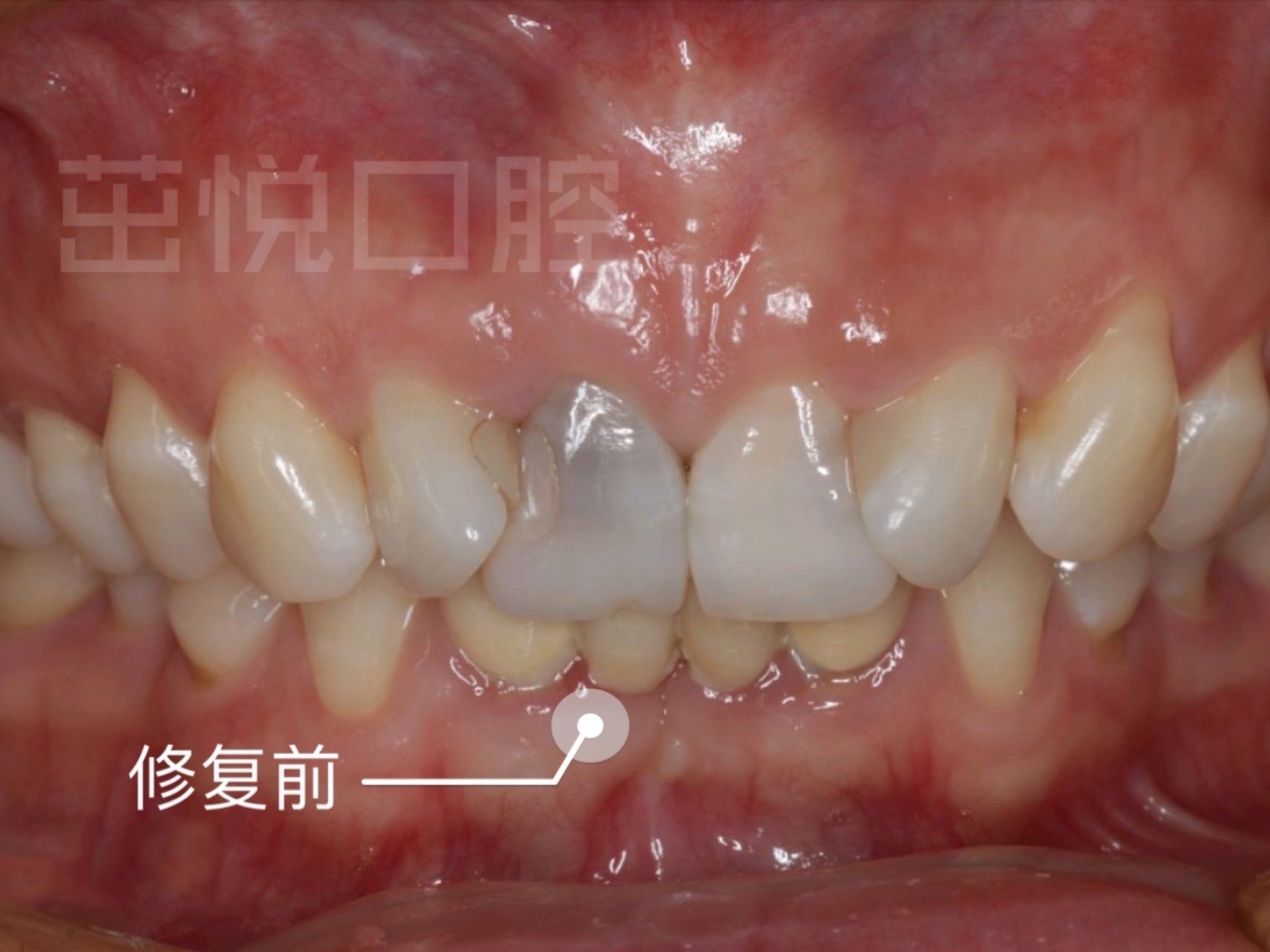 张女士的左上门牙是一颗死髓牙,上牙列的2号牙,3号