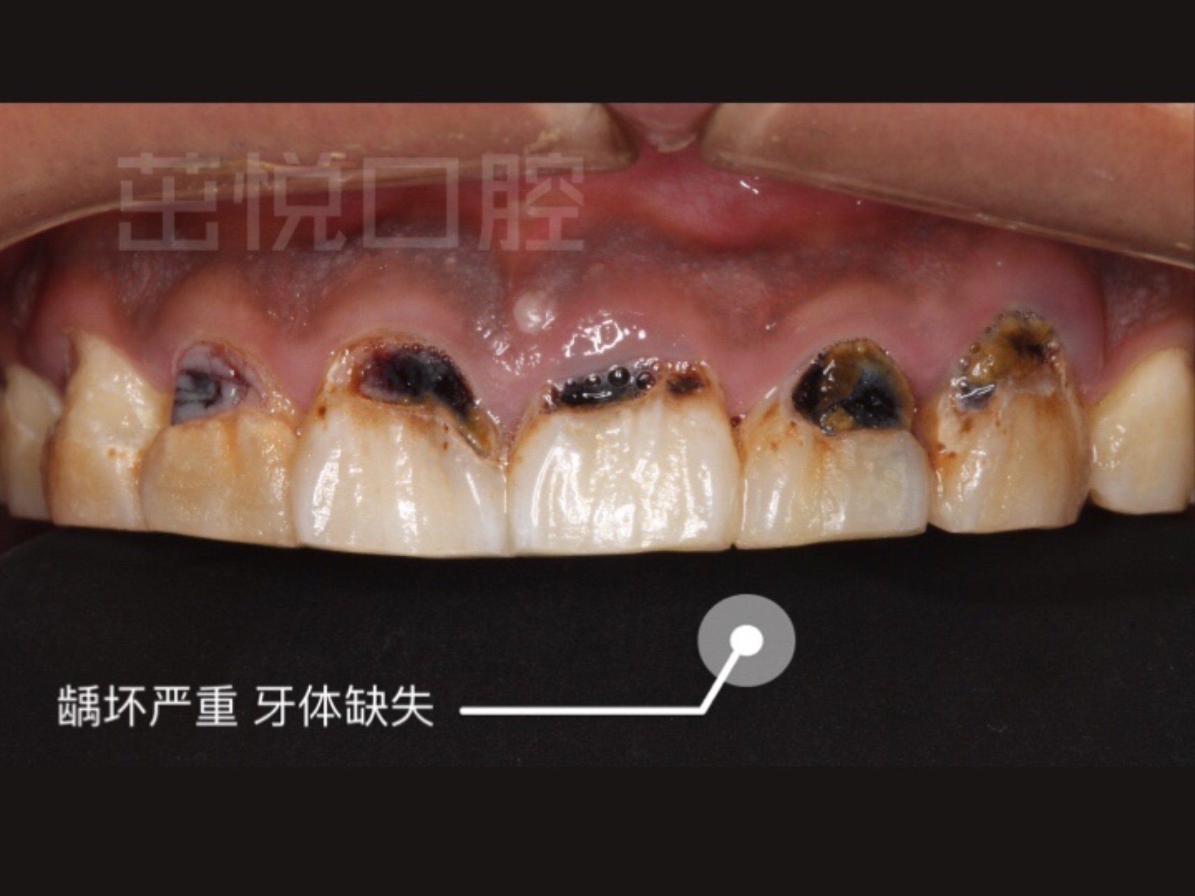 王女士的牙齿颈部龋坏较严重,牙周状态也不好,吃东西_圈子-新氧美容