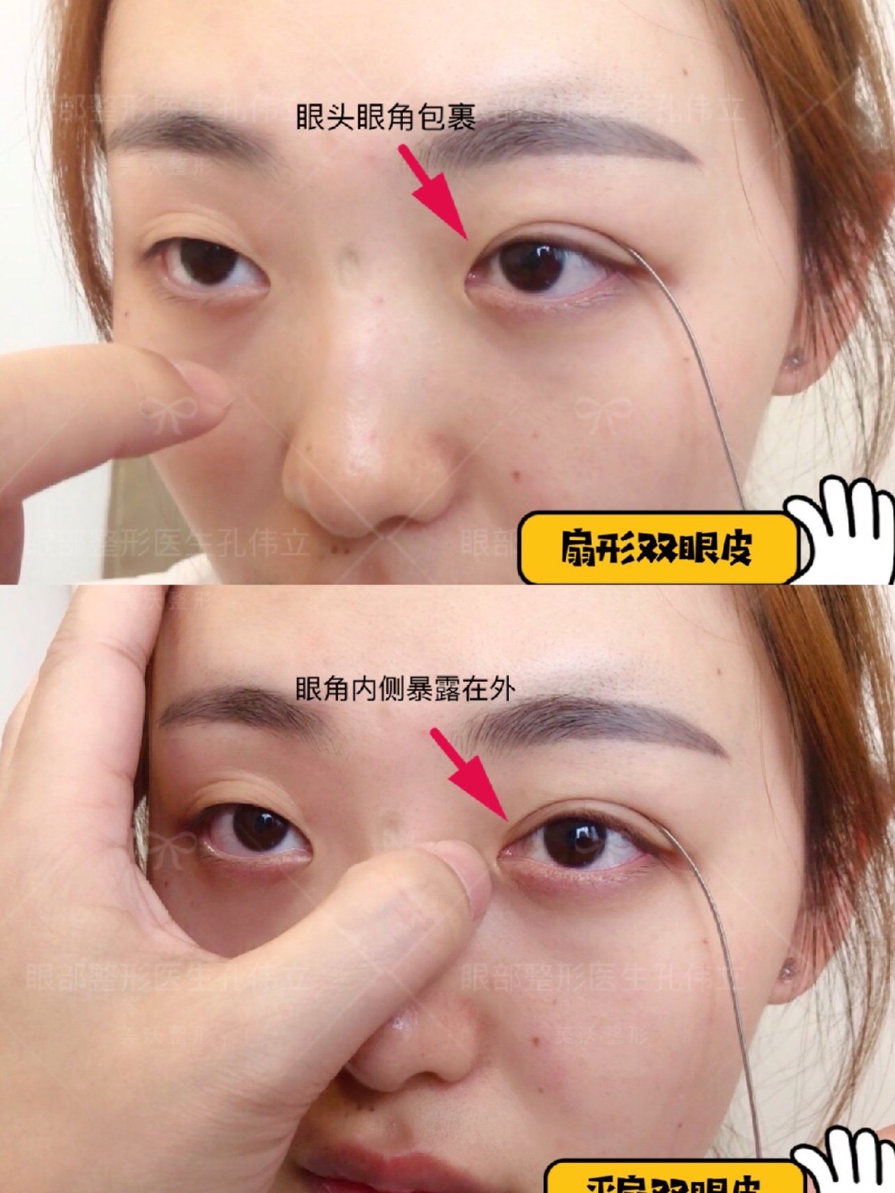 很多人面诊时都分不清扇形和平扇,其实两者根本区别在_圈子-新氧美容