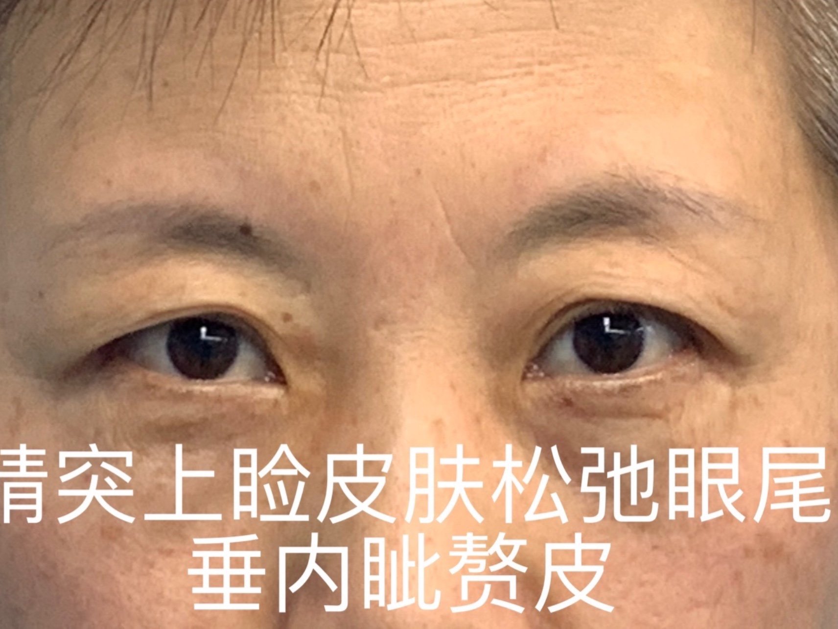 上睑眶周美化年轻化眼睛突,上睑皮肤松弛,眼尾下垂及_圈子-新氧美容