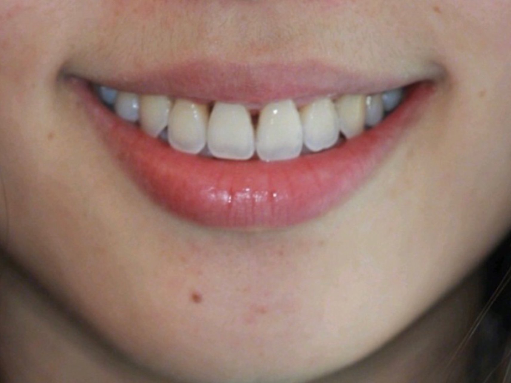 顾客牙缝大 诉求改善牙齿缝隙问题