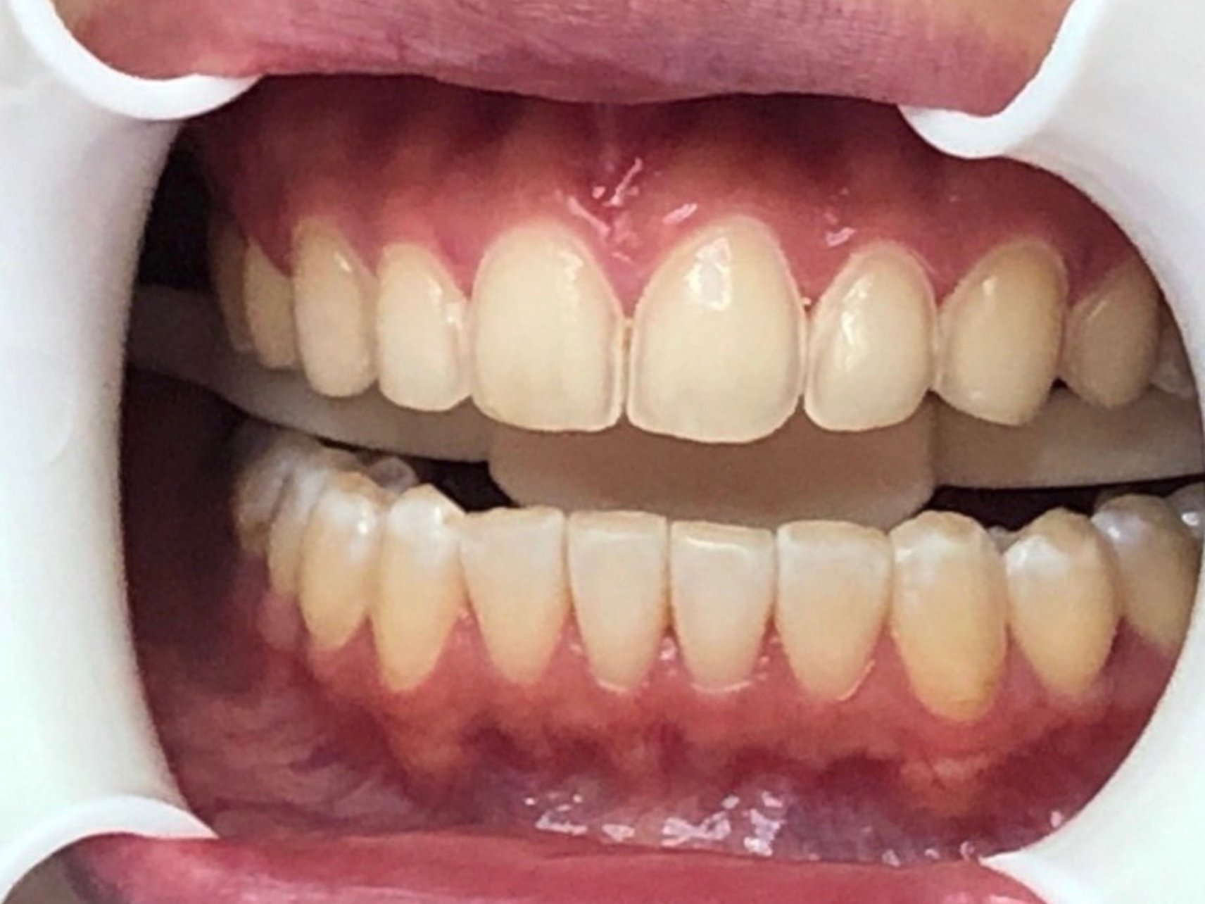 顾客牙齿偏黄还有暗沉等问题想要通过瓷贴面改善