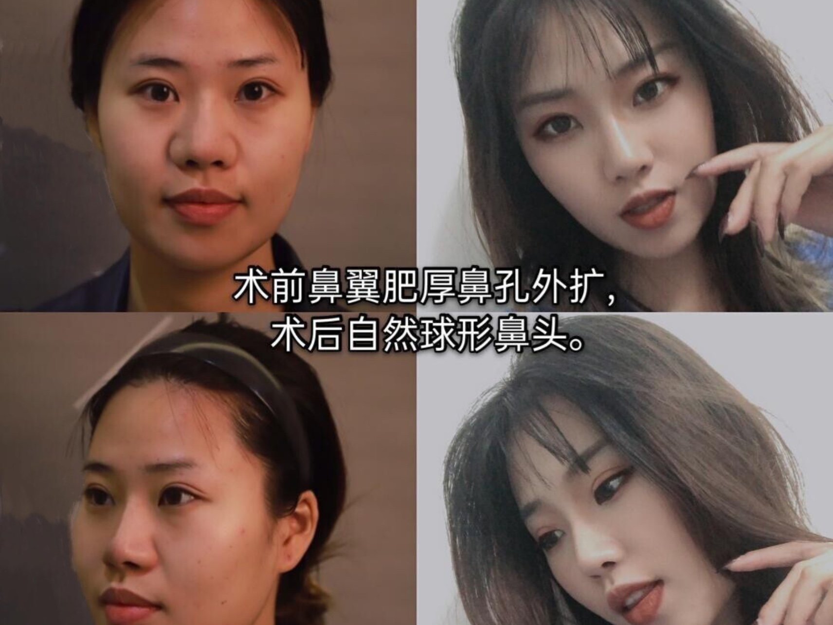 直鼻微翘模板误区避雷