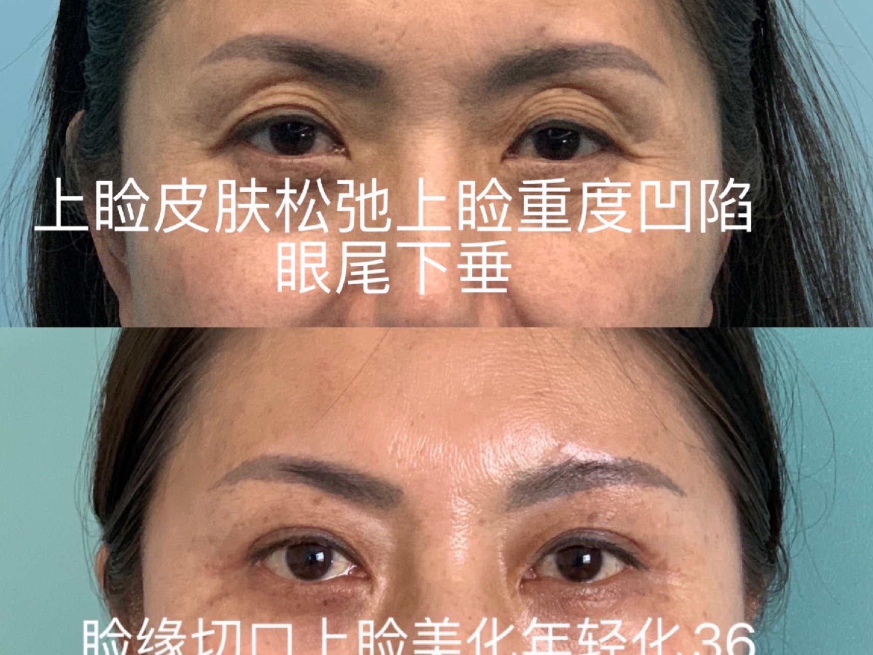 上睑皮肤松弛,弹性减弱,上睑重度凹陷和眼尾下垂,下眼.