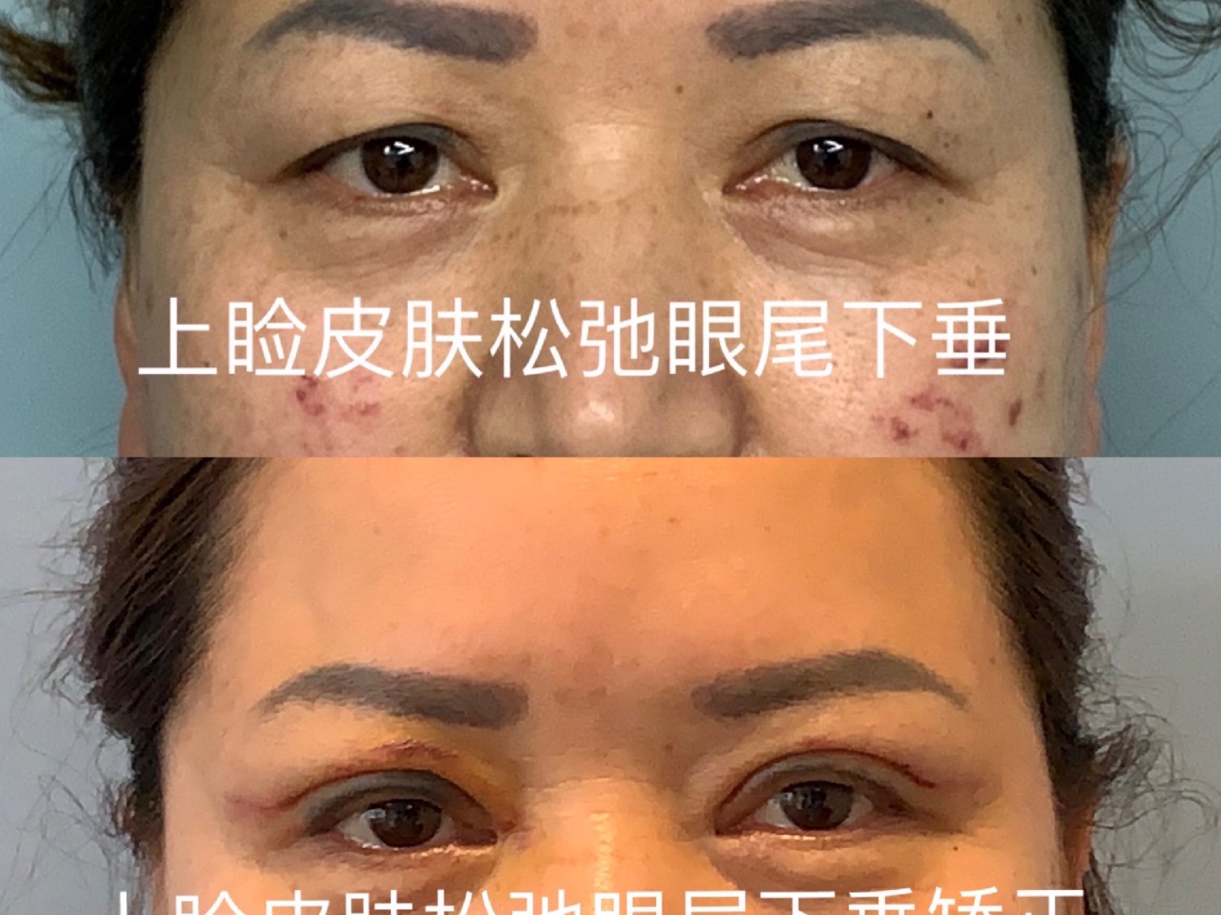 眼尾下垂(三角眼)影响眼睛的形状,是忧郁的感觉,缺少喜感,也是
