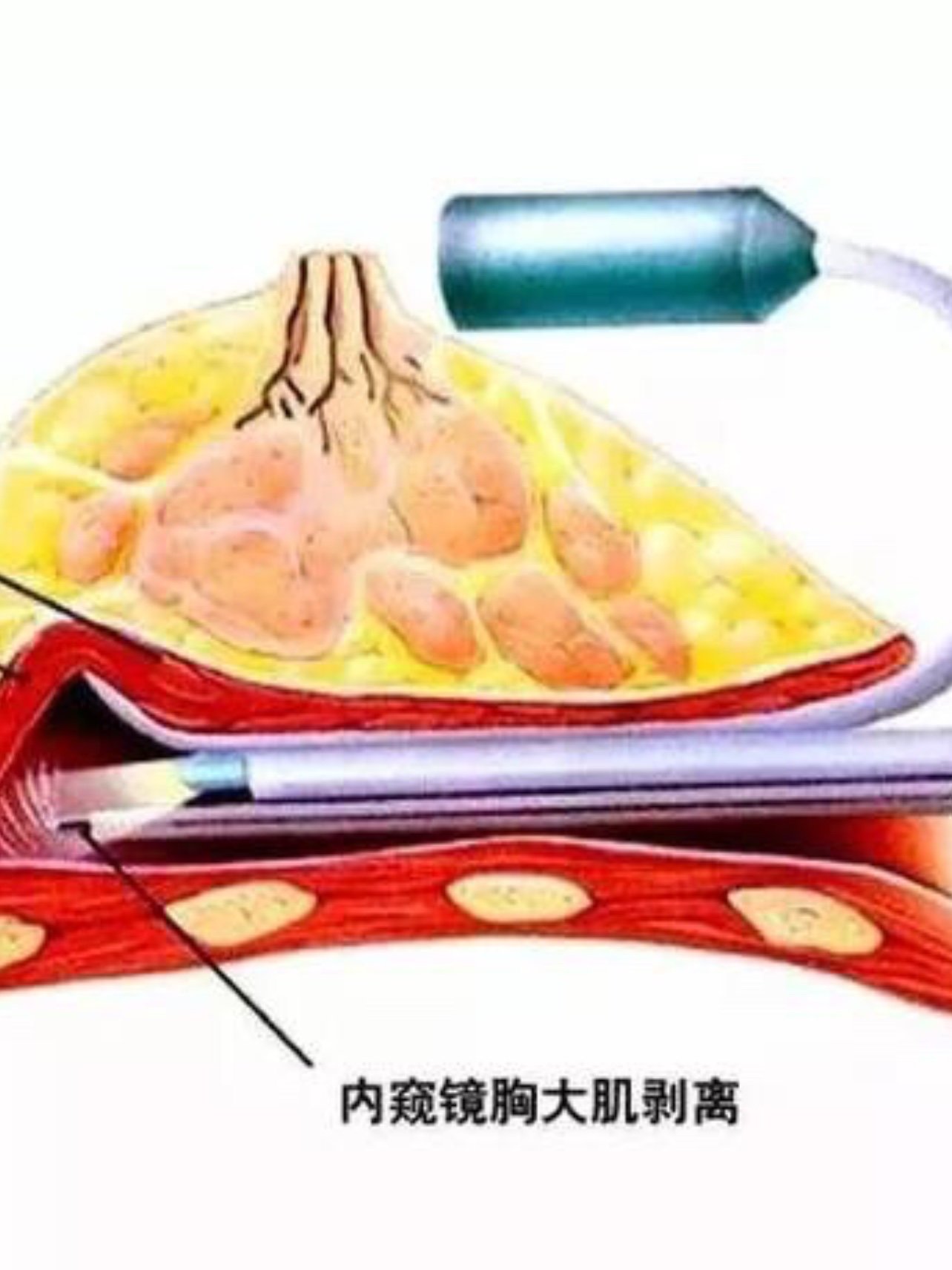 内窥镜隆胸手术的特点