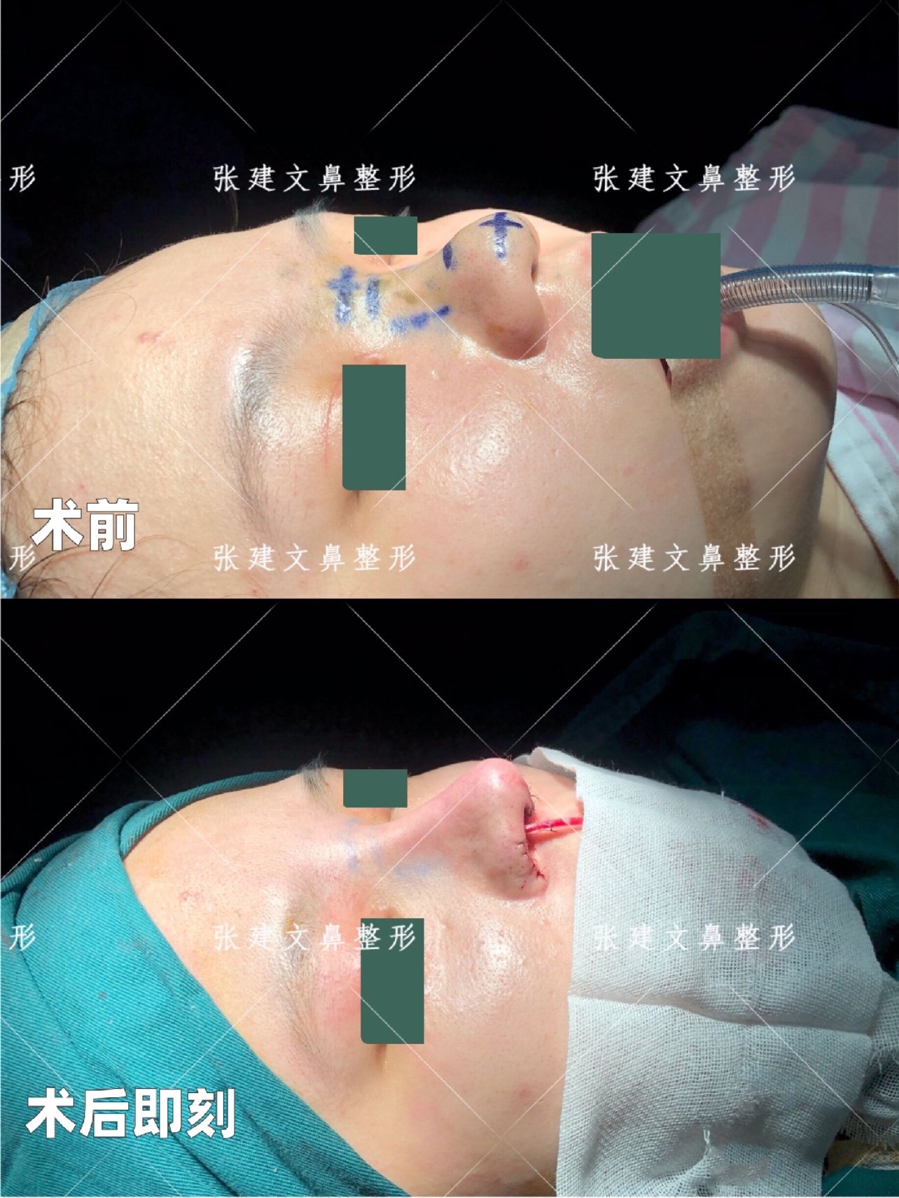 术中方案:自体软骨鼻头塑形鼻小柱延长抬高鼻基底填充鼻翼外切!