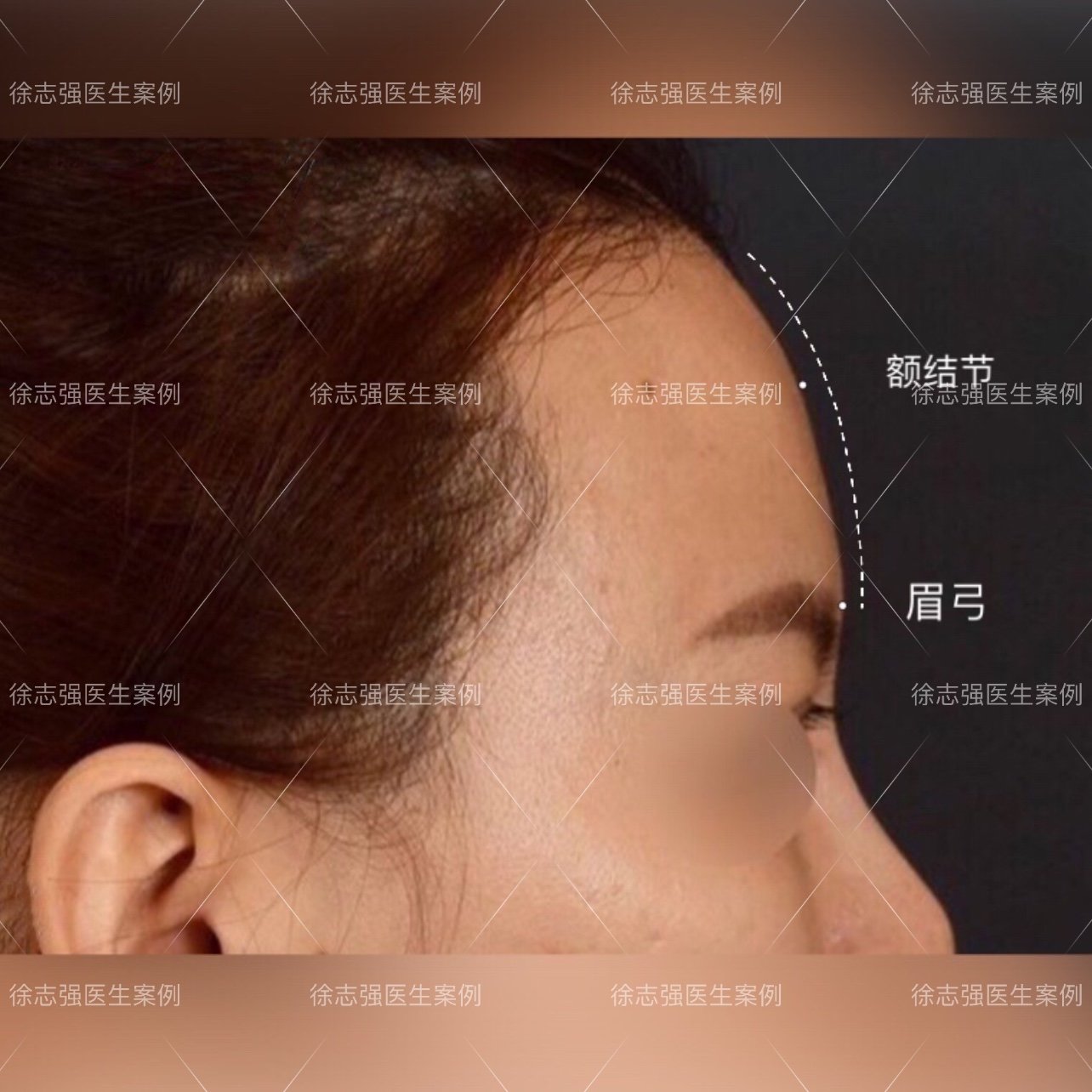 自体脂肪丰额头 适量填充额沟凹陷区域,缩减额结节与