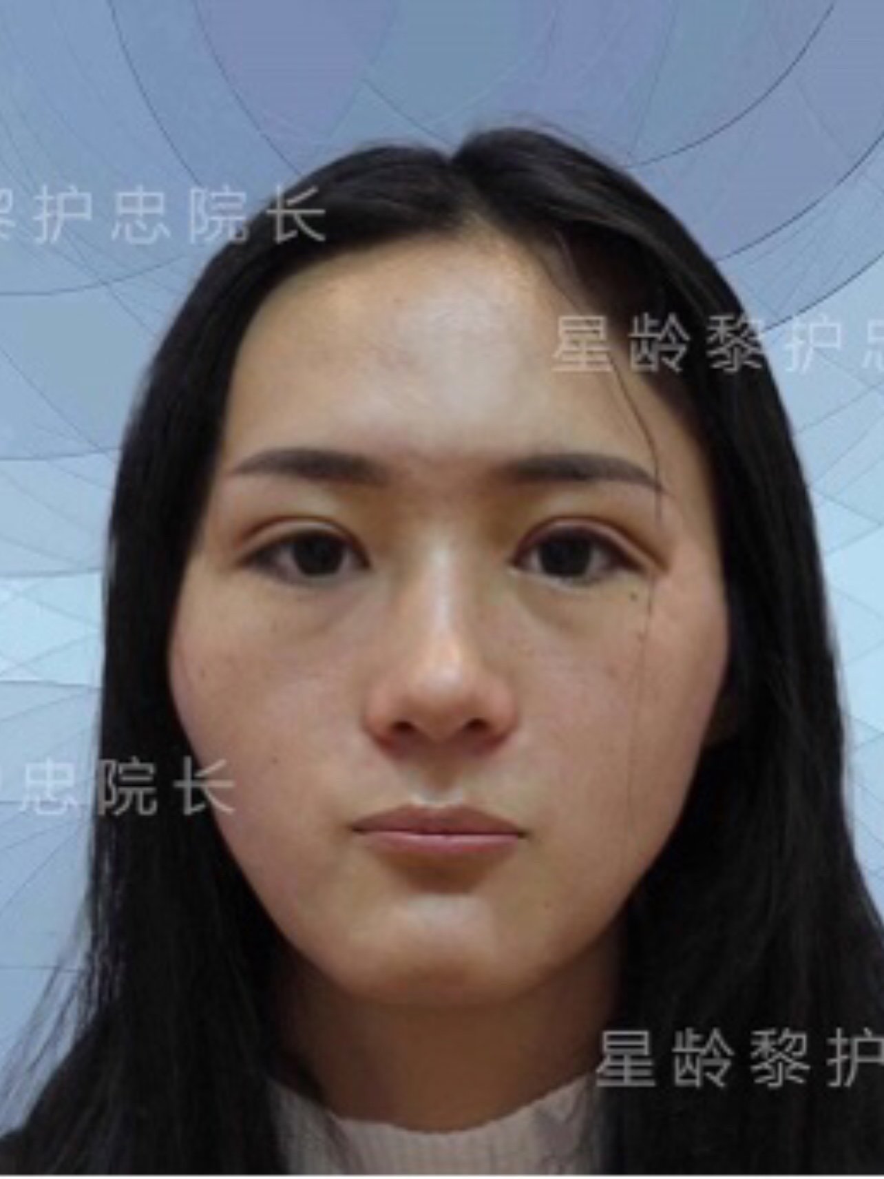 求美者术前额头扁平,太阳穴凹陷显得颧骨高,泪沟明显,面颊线条不流畅