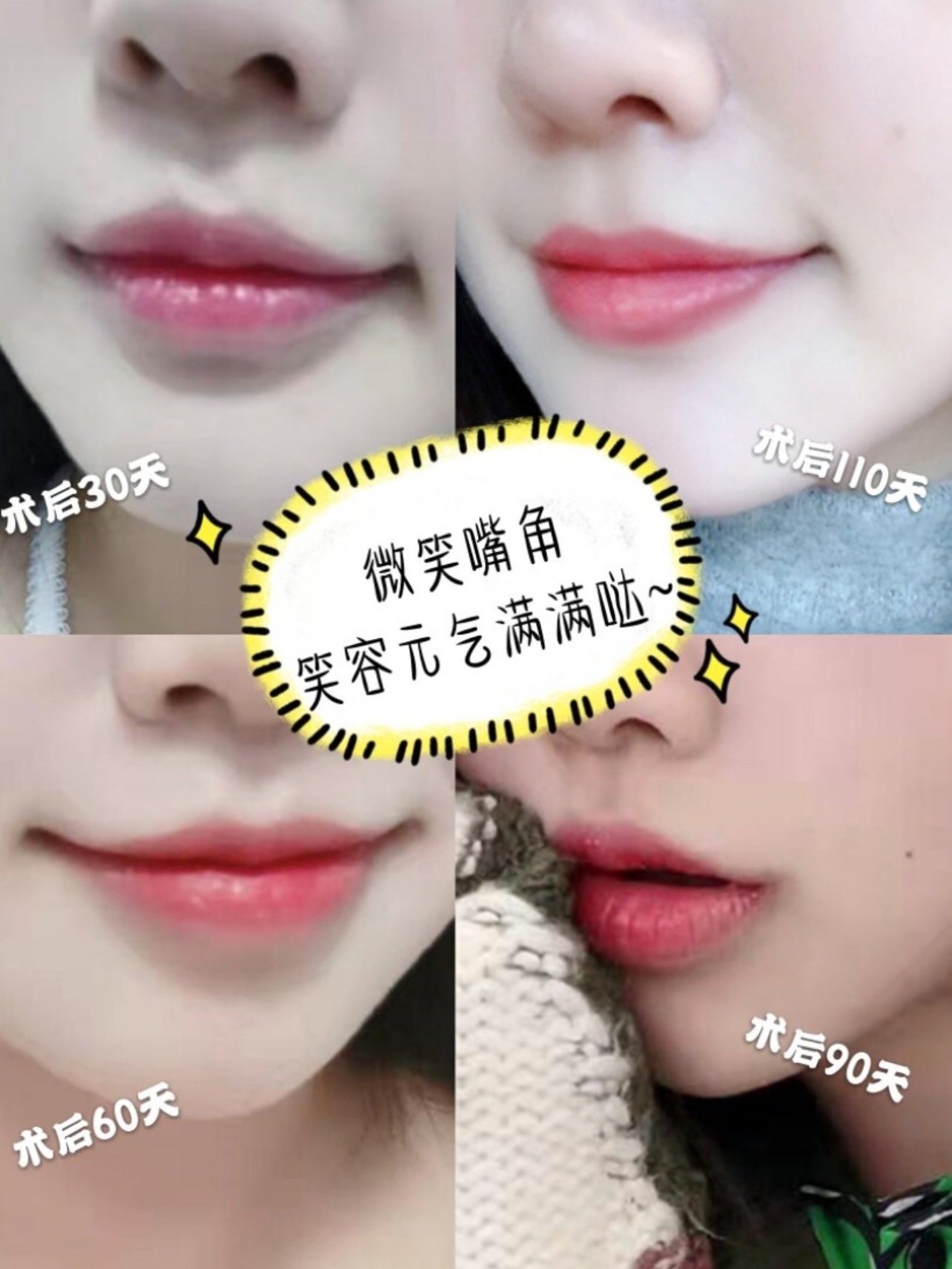 案例是去年九月份做的一个微笑唇案例,这个姑娘当时来的时候肉嘟嘟的