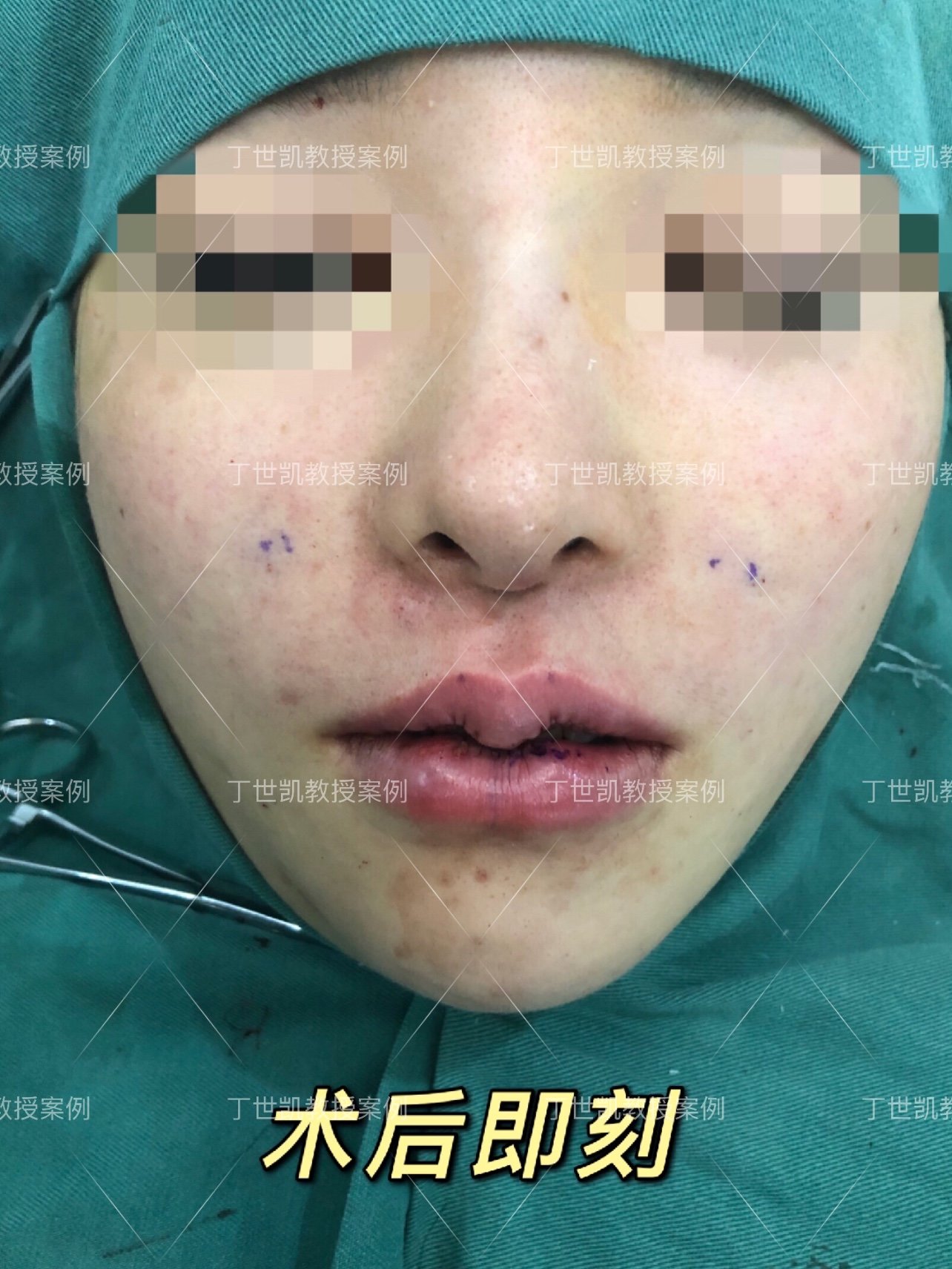 m唇手术 m唇唇型变好看,唇峰,唇谷明显,唇线