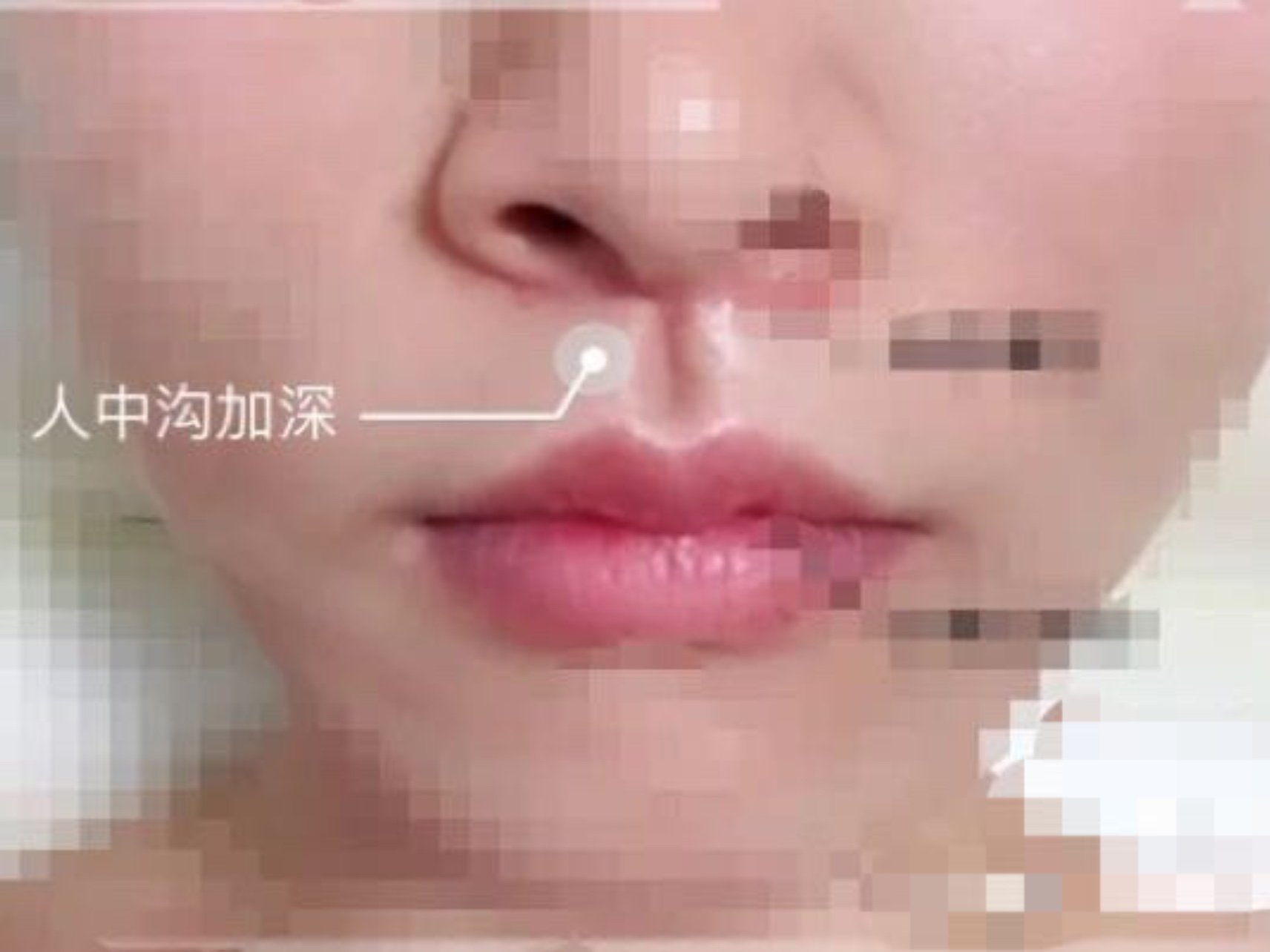 给大家来分享我的人中窝加深效果啦,术后15天～化妆_圈子-新氧美容