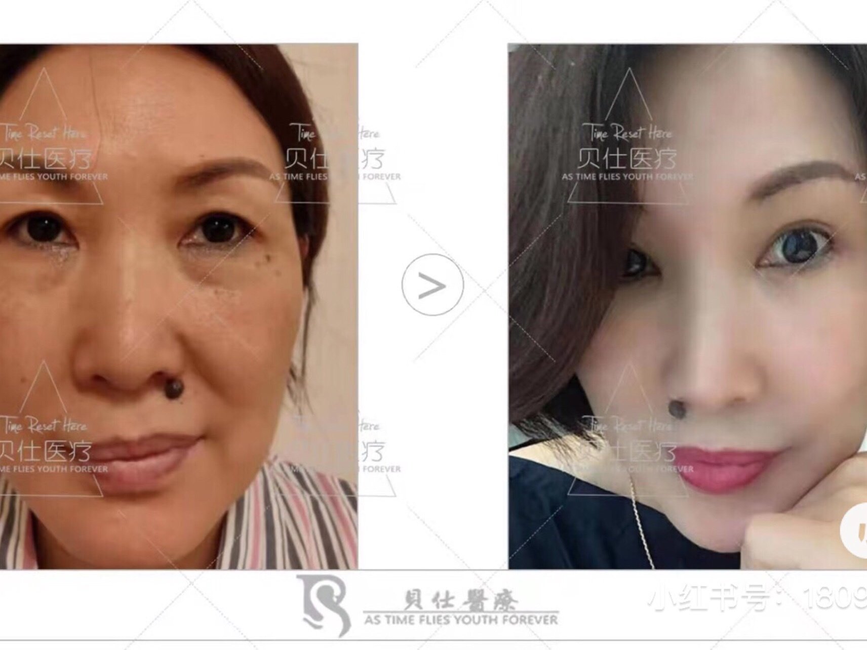 今天来说一说卧蚕和眼袋的区别