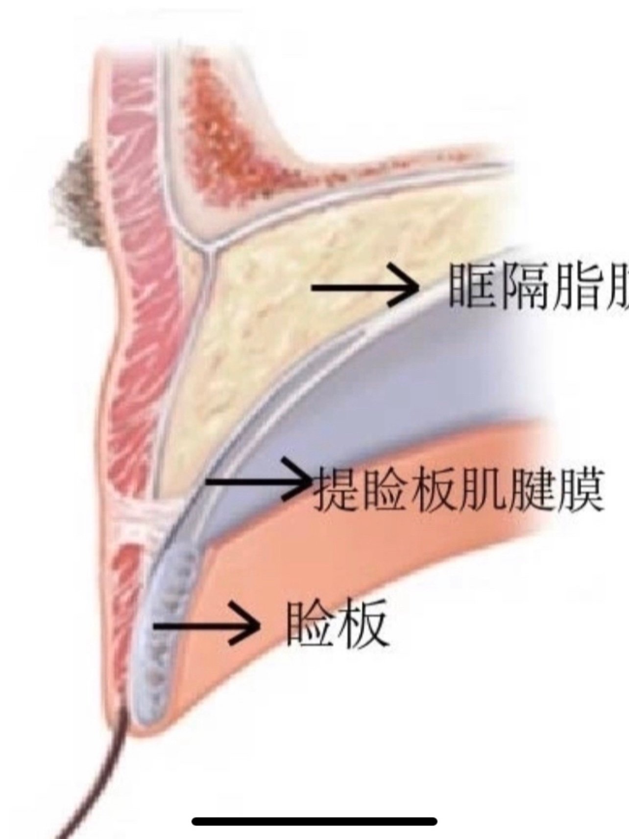 双眼皮的形成原理