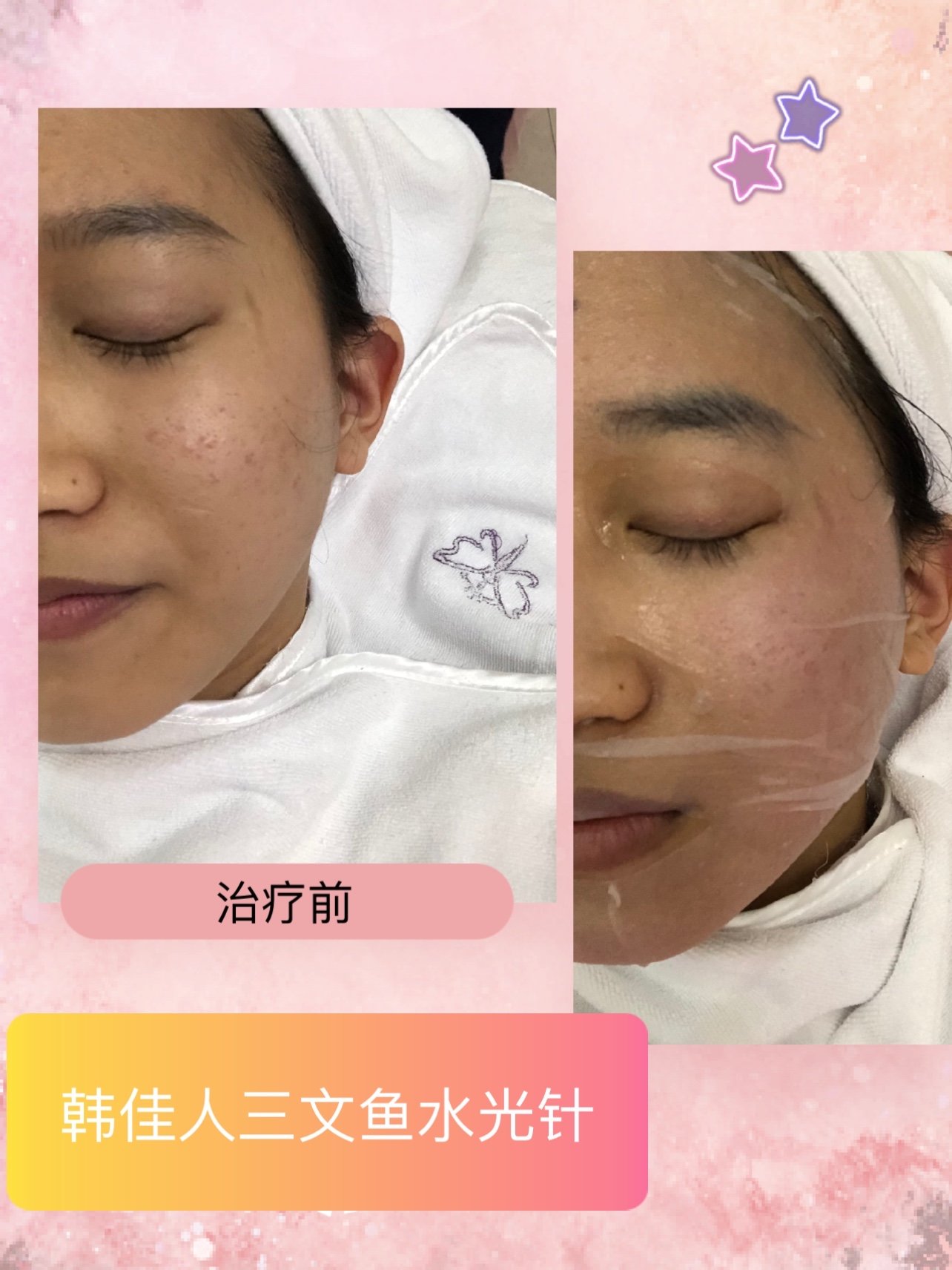 韩佳人三文鱼微水光体验