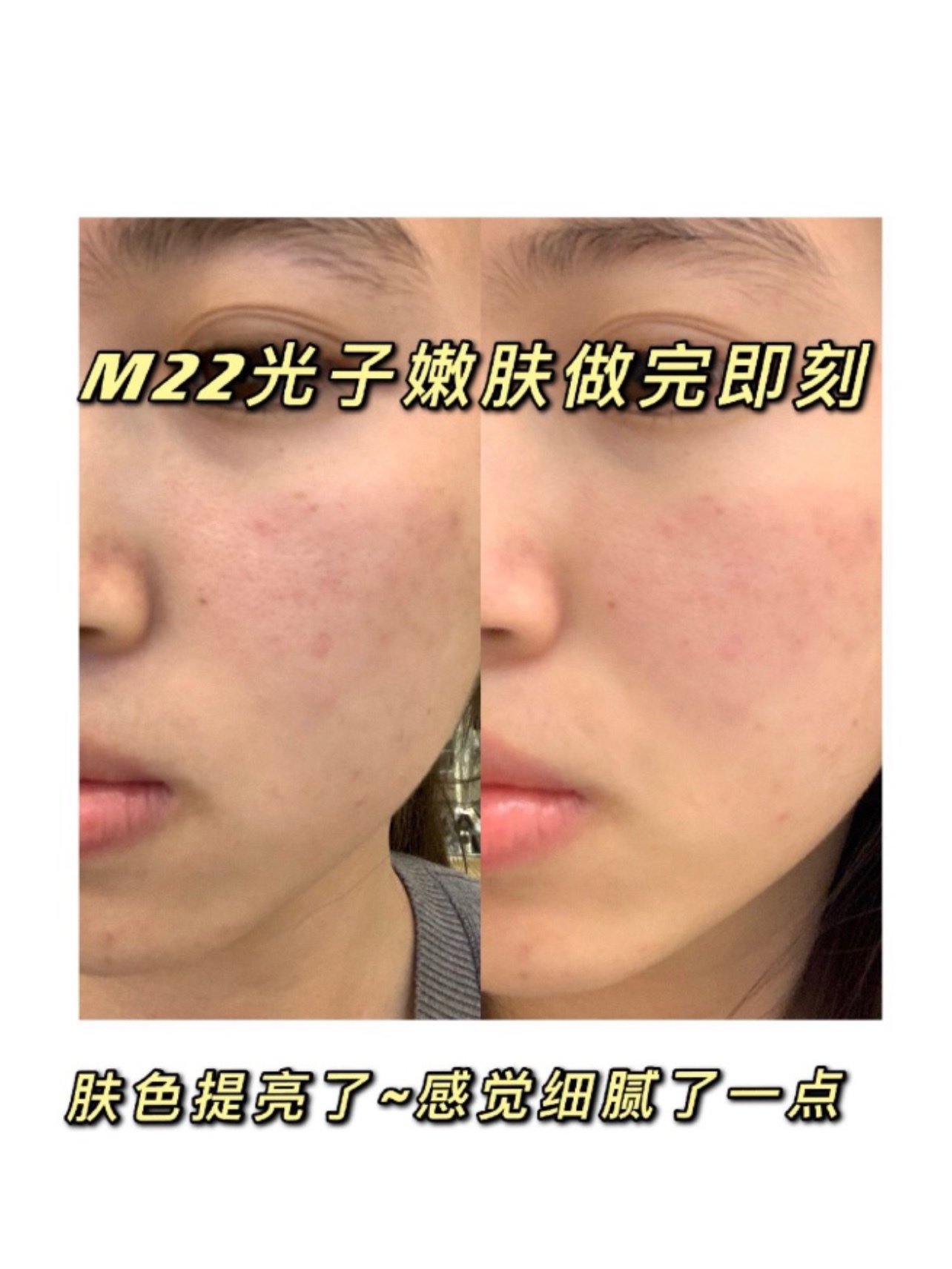 上一次我做完光子嫩肤因为护理不当,我反黑了好久,这次做完光子嫩肤