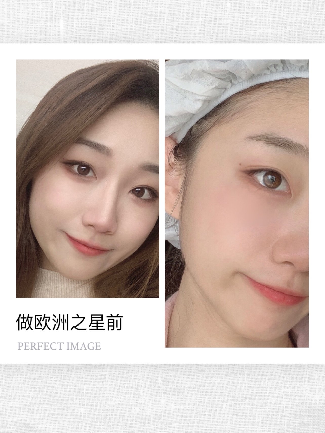 欧洲之星的效果也太绝了吧!我做的是fotona4_圈子-新氧美容整形