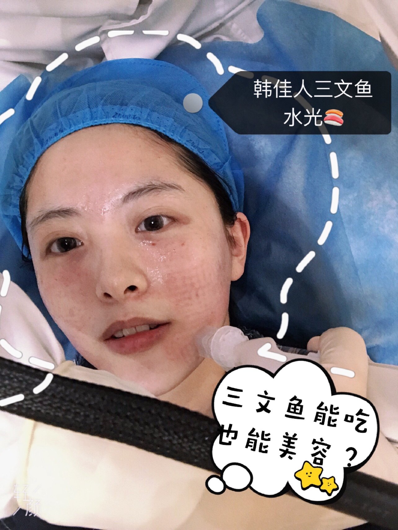 今天去杭州瑞晶整形医院体验了韩佳人三文鱼水光补水