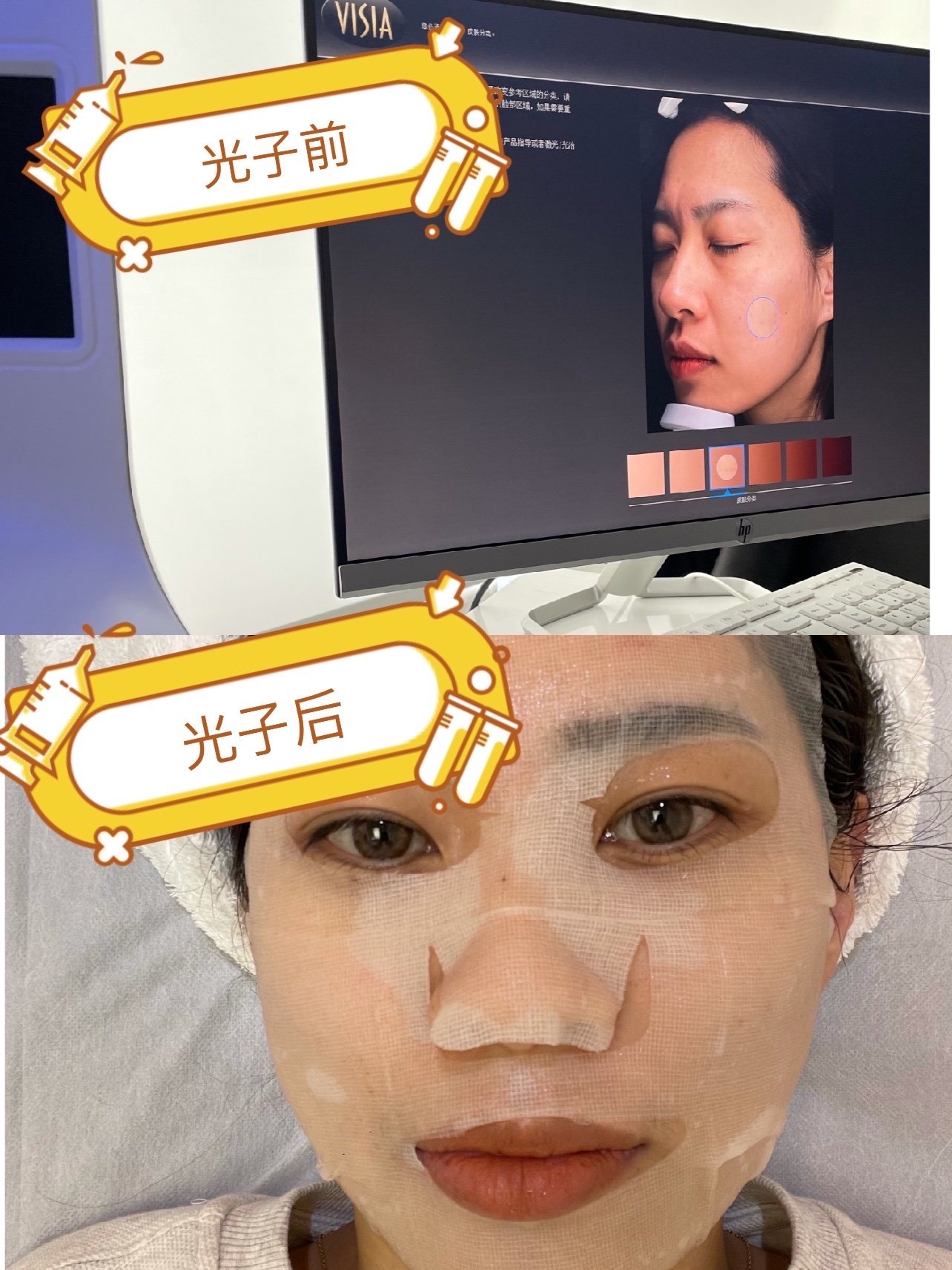只要洗完脸,涂上凝胶就可以操作了,这次用的是赛诺龙光子嫩肤仪,感觉