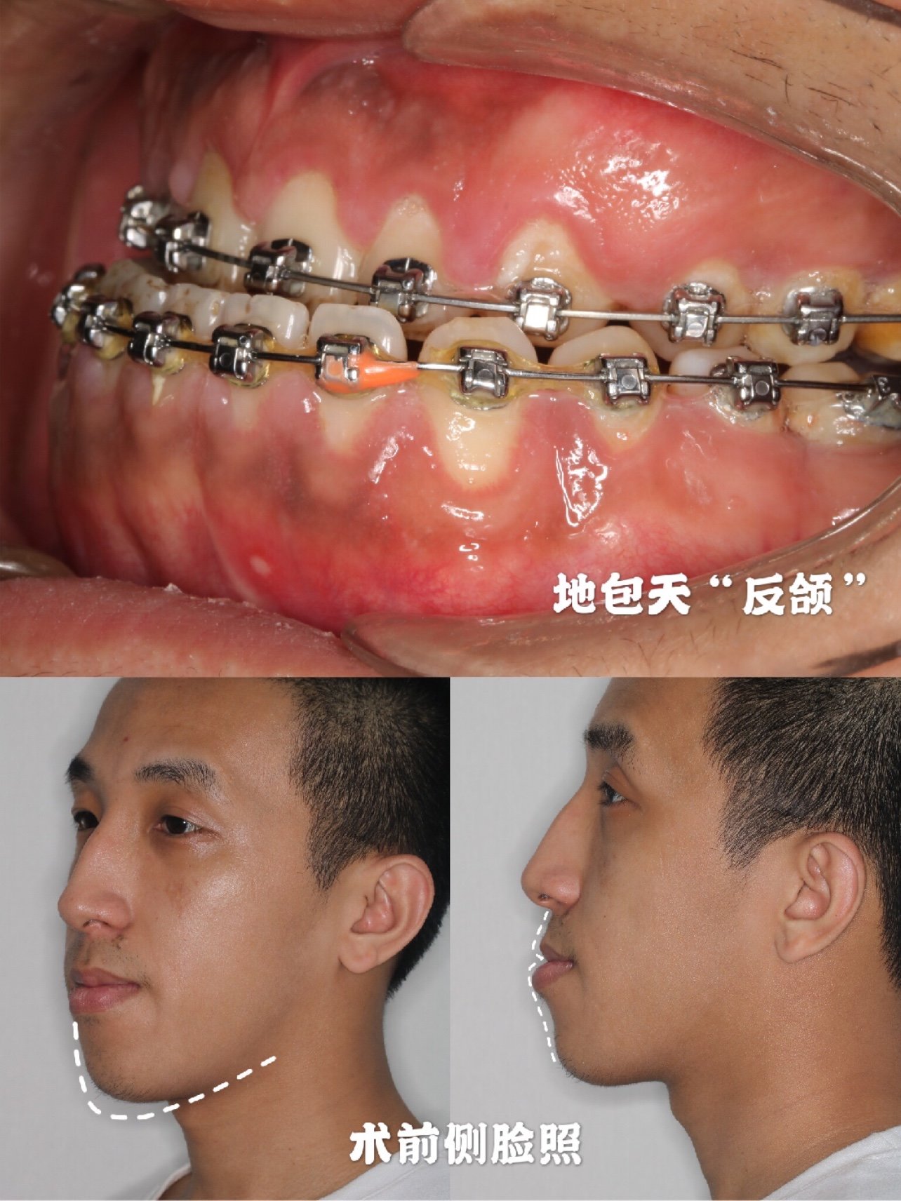 正畸正颌手术告别地包天,偏颌,牙齿畸形问题