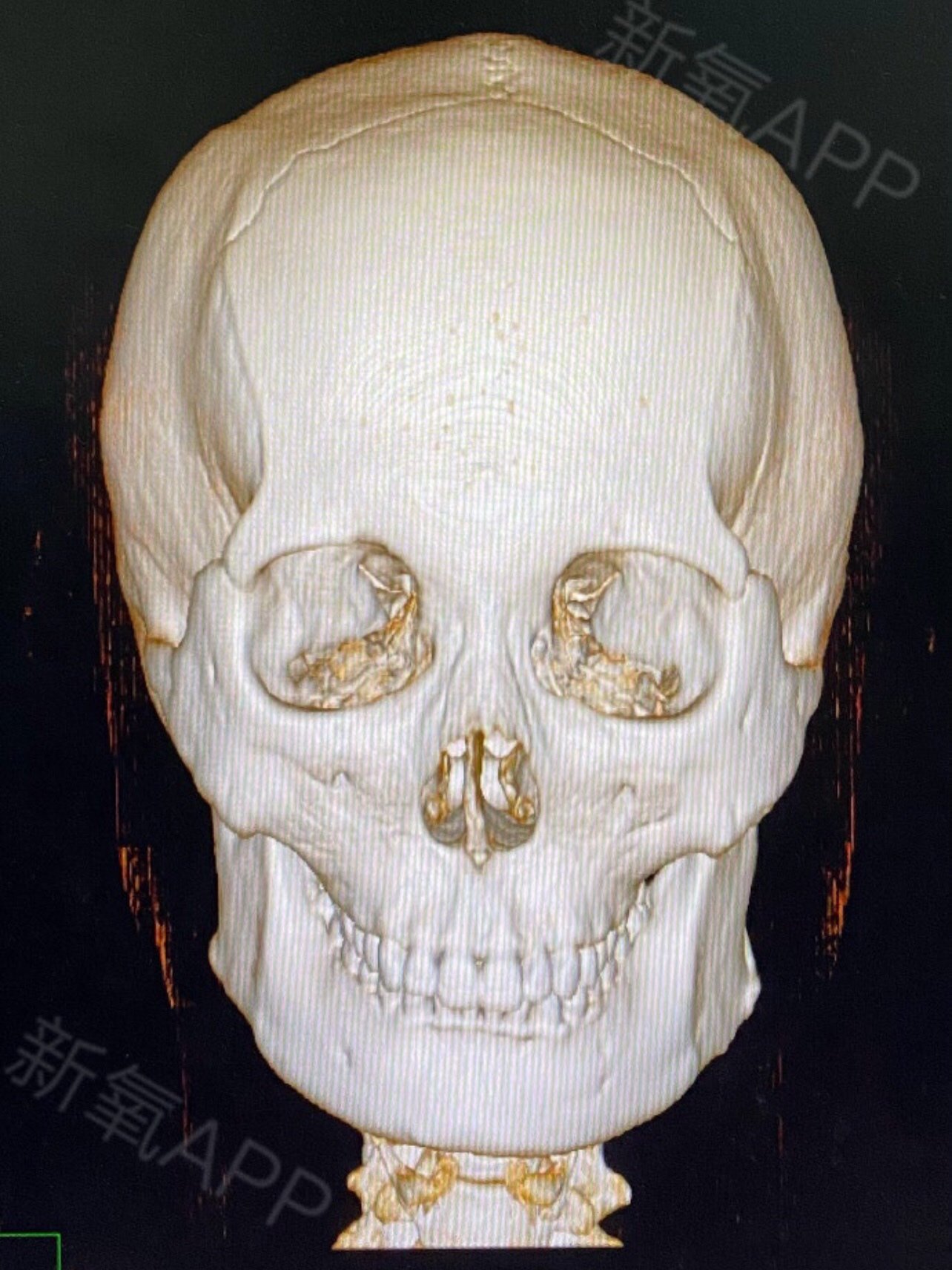 (指下颌角肥大,近似于90,侧面非常明显 下颌角外翻型(指下颌角宽大