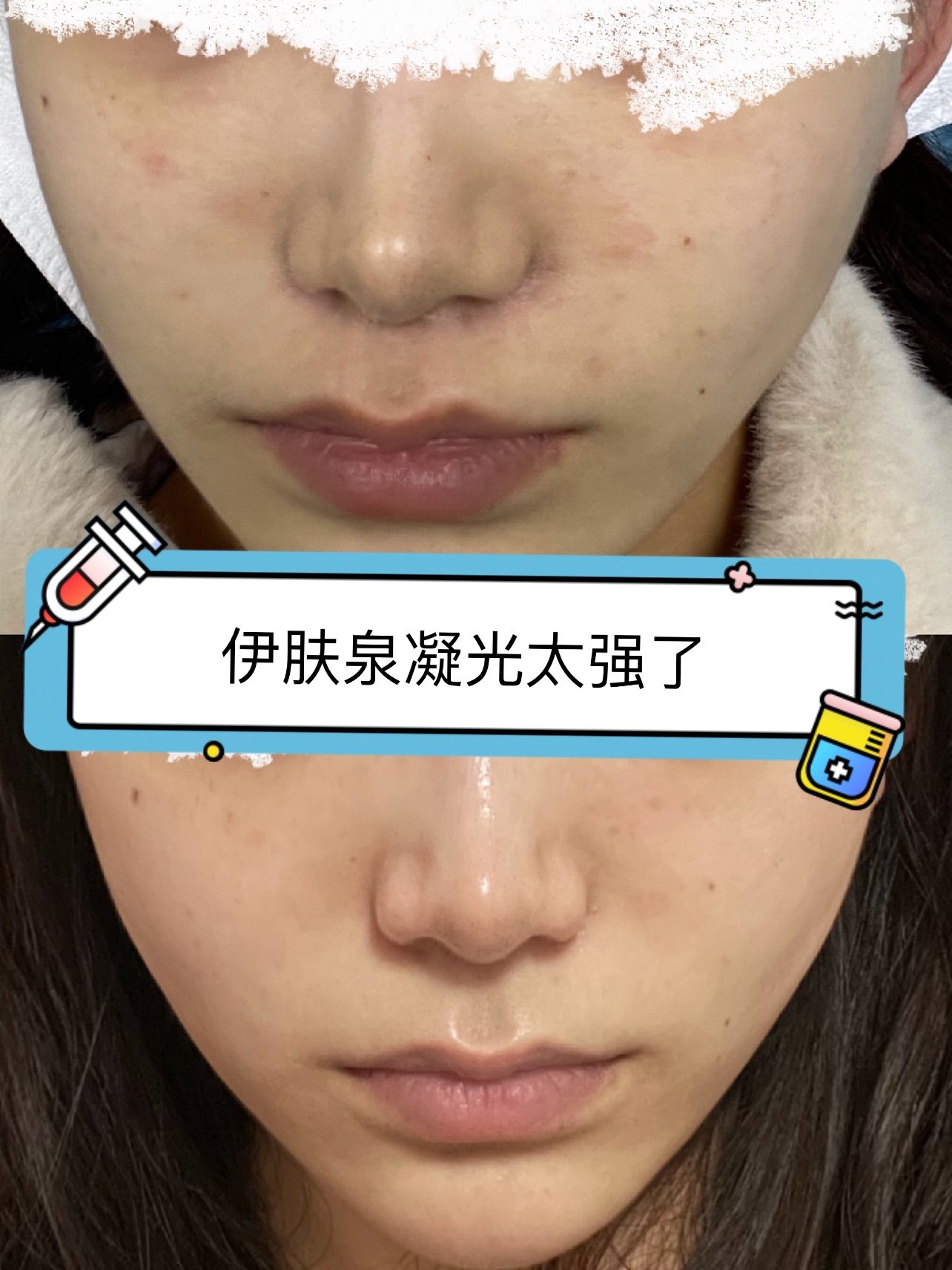 伊肤泉凝光注射已经7天啦!