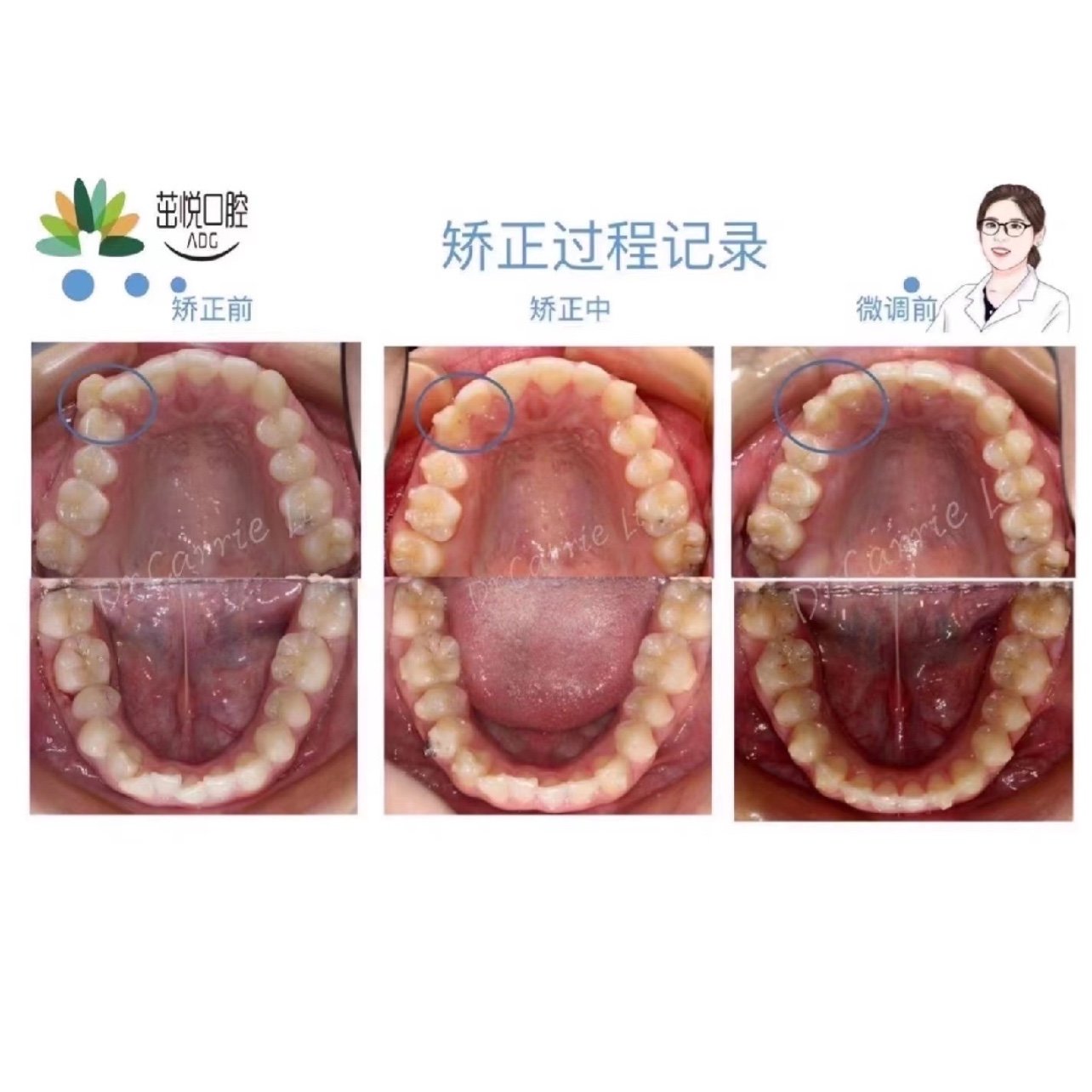 上颌牙齿排列不齐,小虎牙在牙弓外,影响美观,中线不齐