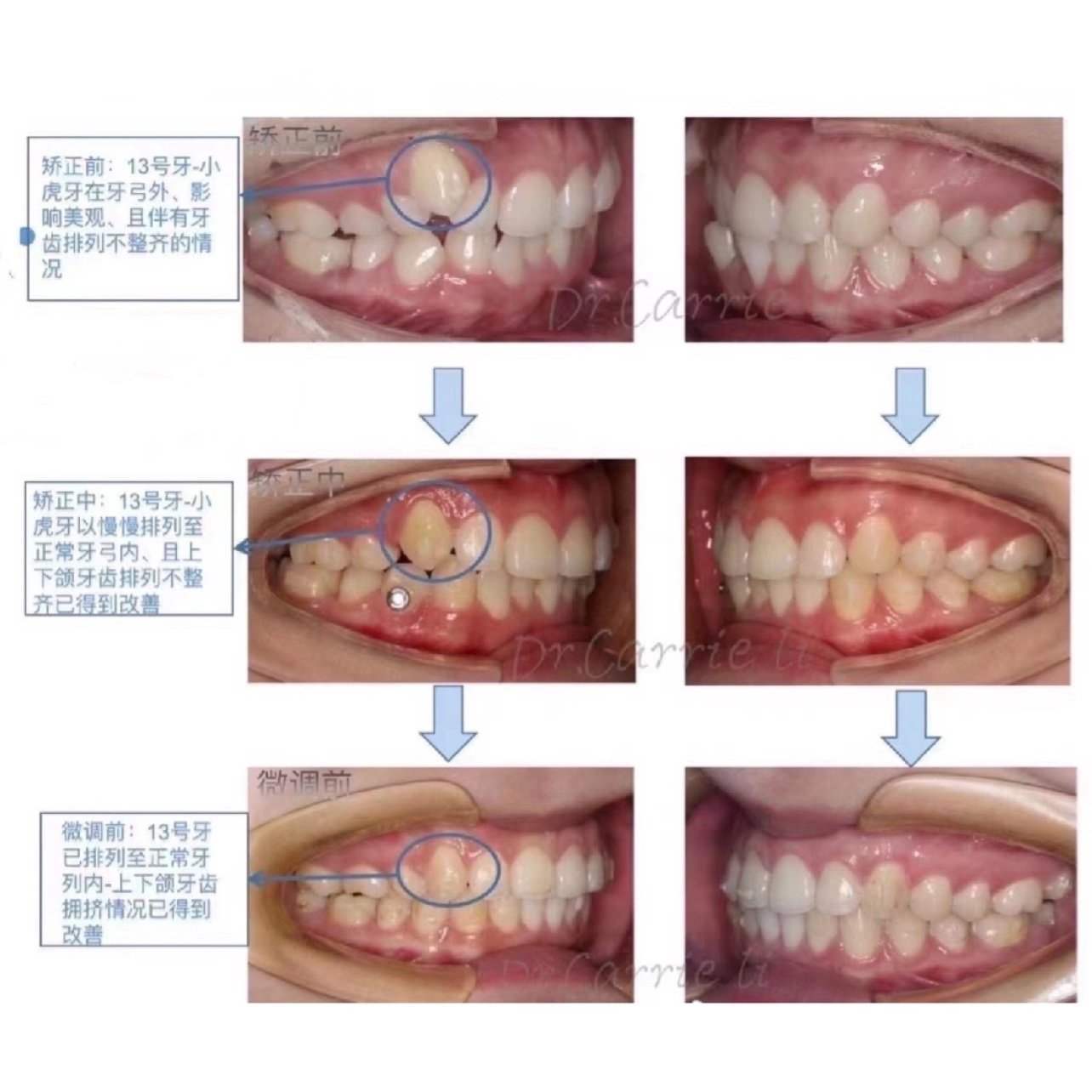 上颌牙齿排列不齐,小虎牙在牙弓外,影响美观,中线不齐