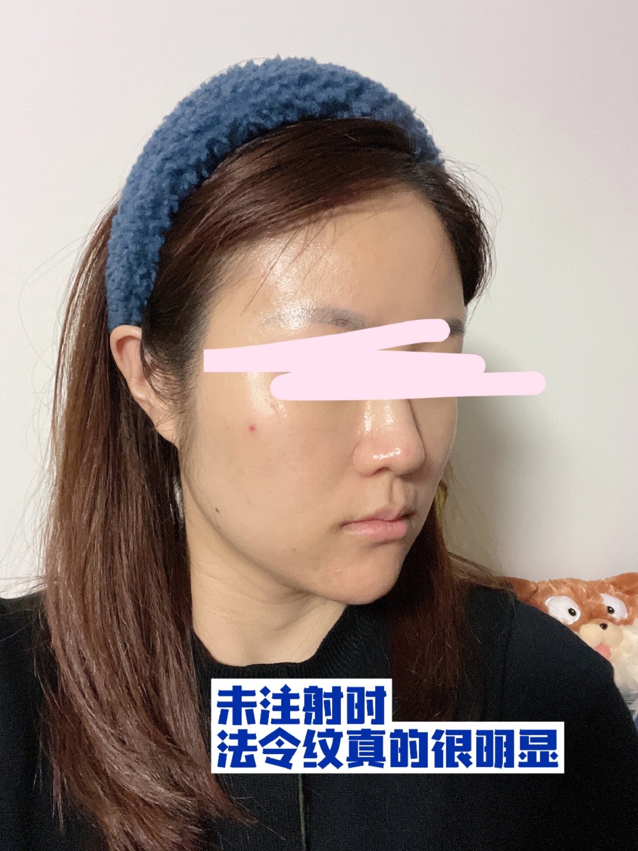 我一直有鼻基底凹陷的问题,所以在一个月前做了鼻基底玻尿酸填充的