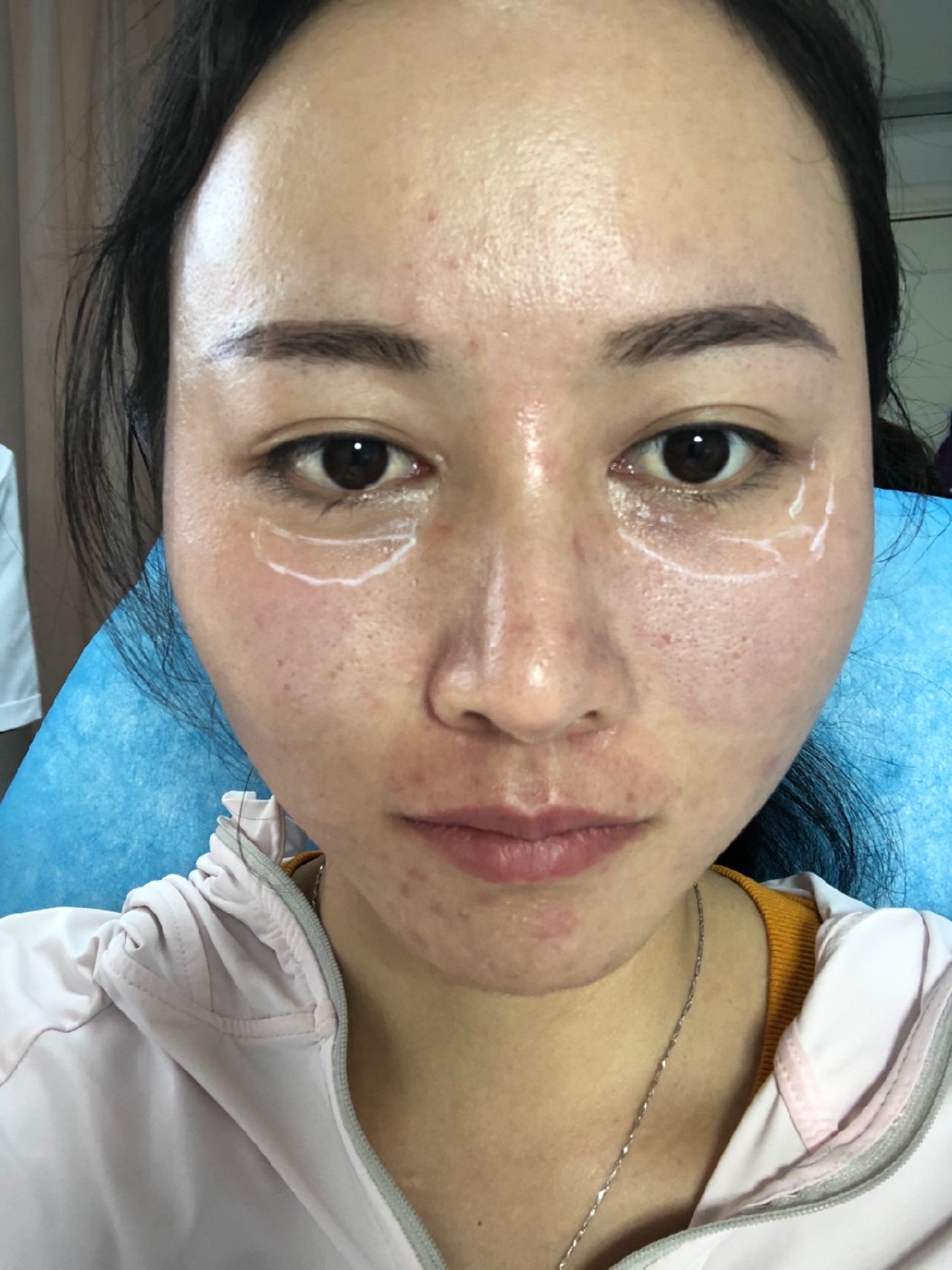 泪沟严重凹陷,注射嗨体熊猫针效果立竿见影!医生手法
