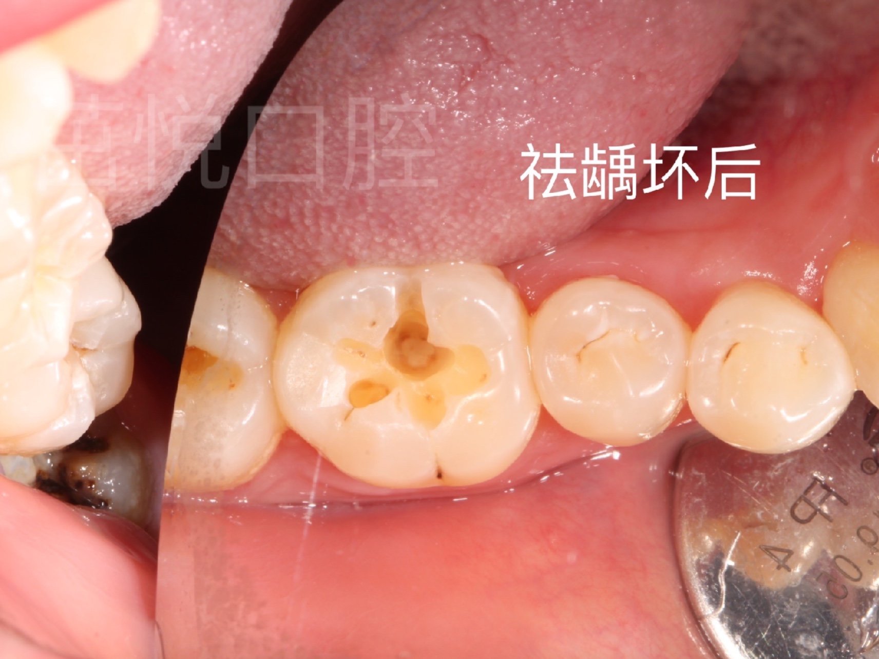 2,因牙体缺损引起邻面接触