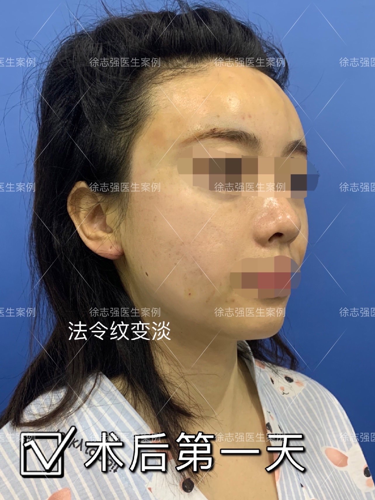 法令纹,俗称鼻唇沟,是位于颧颊部与上唇之间充当分界