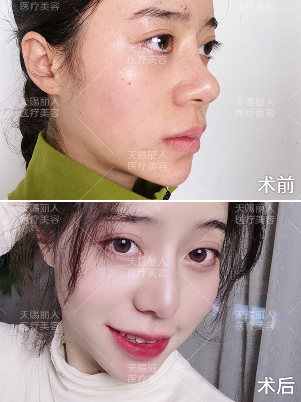 统一鼻整形审美的鼻子长什么样?鼻畸形篇