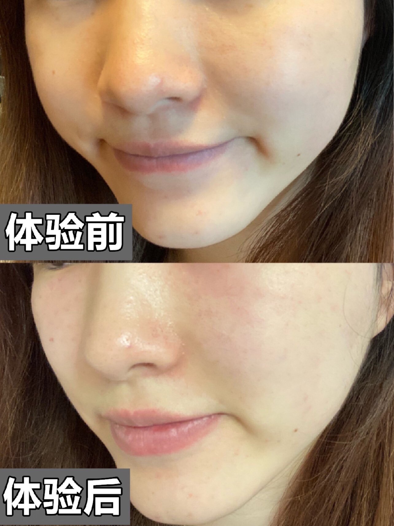 【光子嫩肤】黑金dpl超光子 全面部 美白嫩肤 淡化色斑 1次超光子=3次