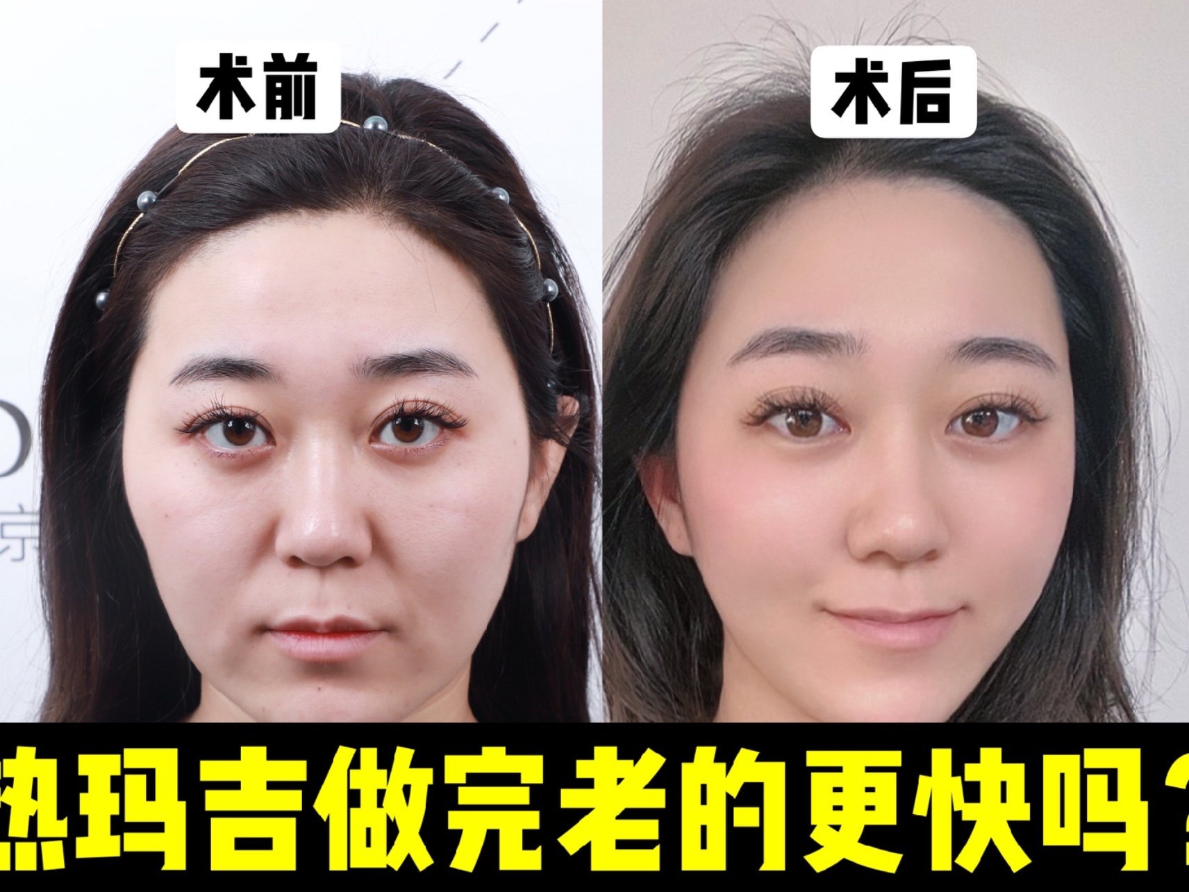 有抗衰的求美者经常会问做完热玛吉会不会老得更快呢?