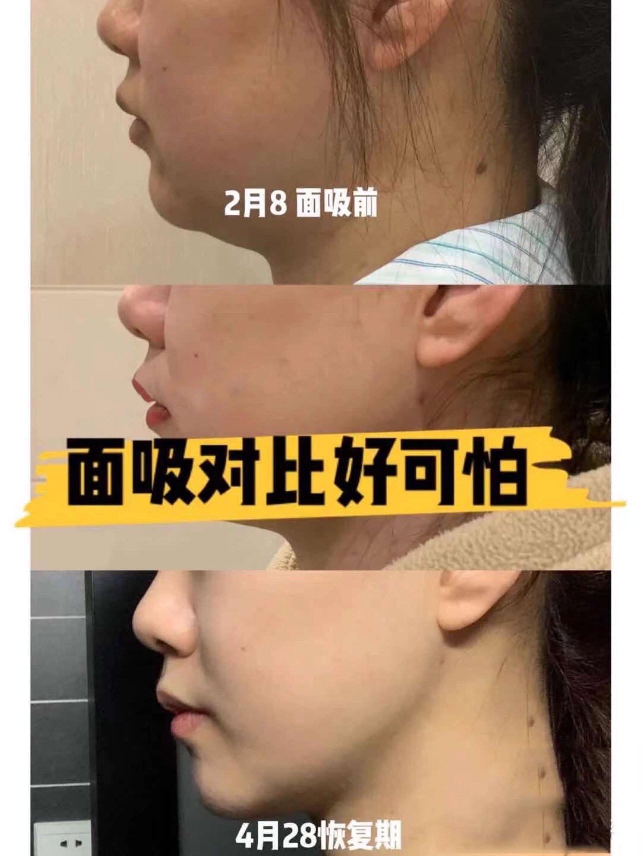 【求美者自诉】我是属于脸肉肉的婴儿肥,再加上双下巴