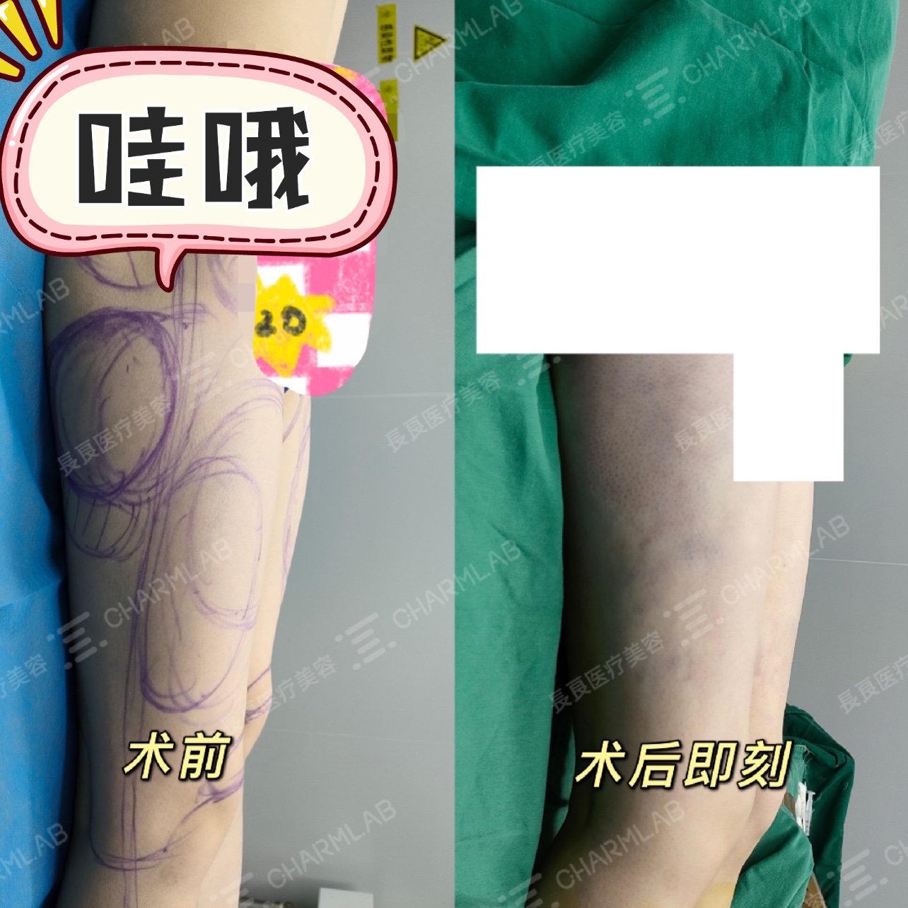 案例分享大腿环吸臀线吸脂