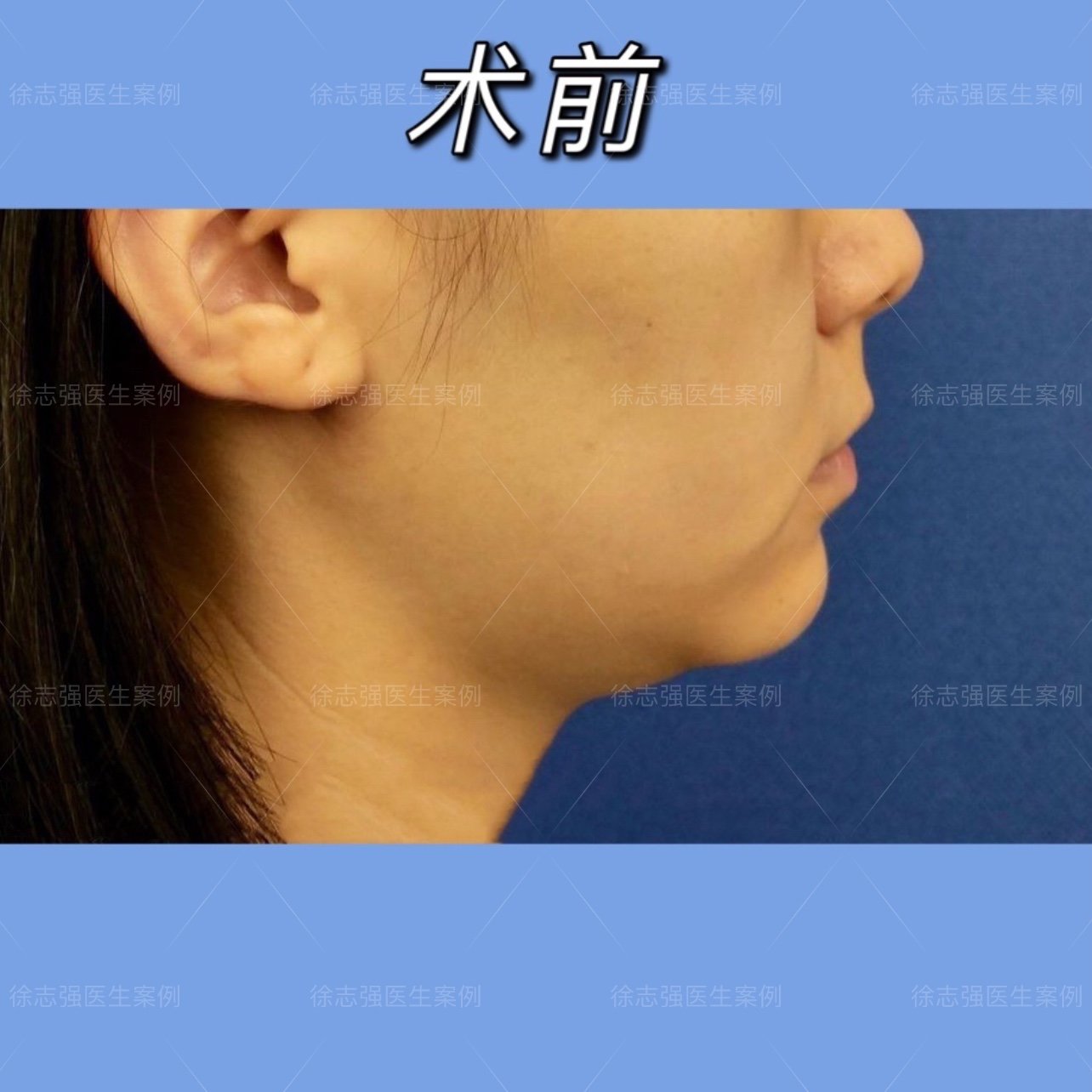 下面部脂肪堆积过多,面颊向外突出,下颌缘线模糊,显脸胖.