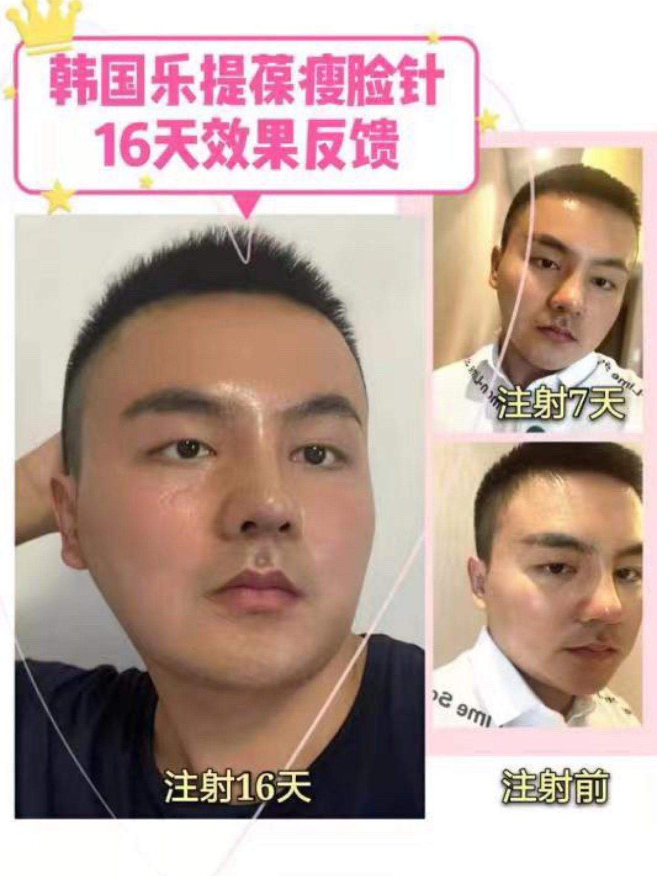 哈喽,大家好我是乐提葆瘦脸针体验官程sir,今天是_圈子-新氧美容整形