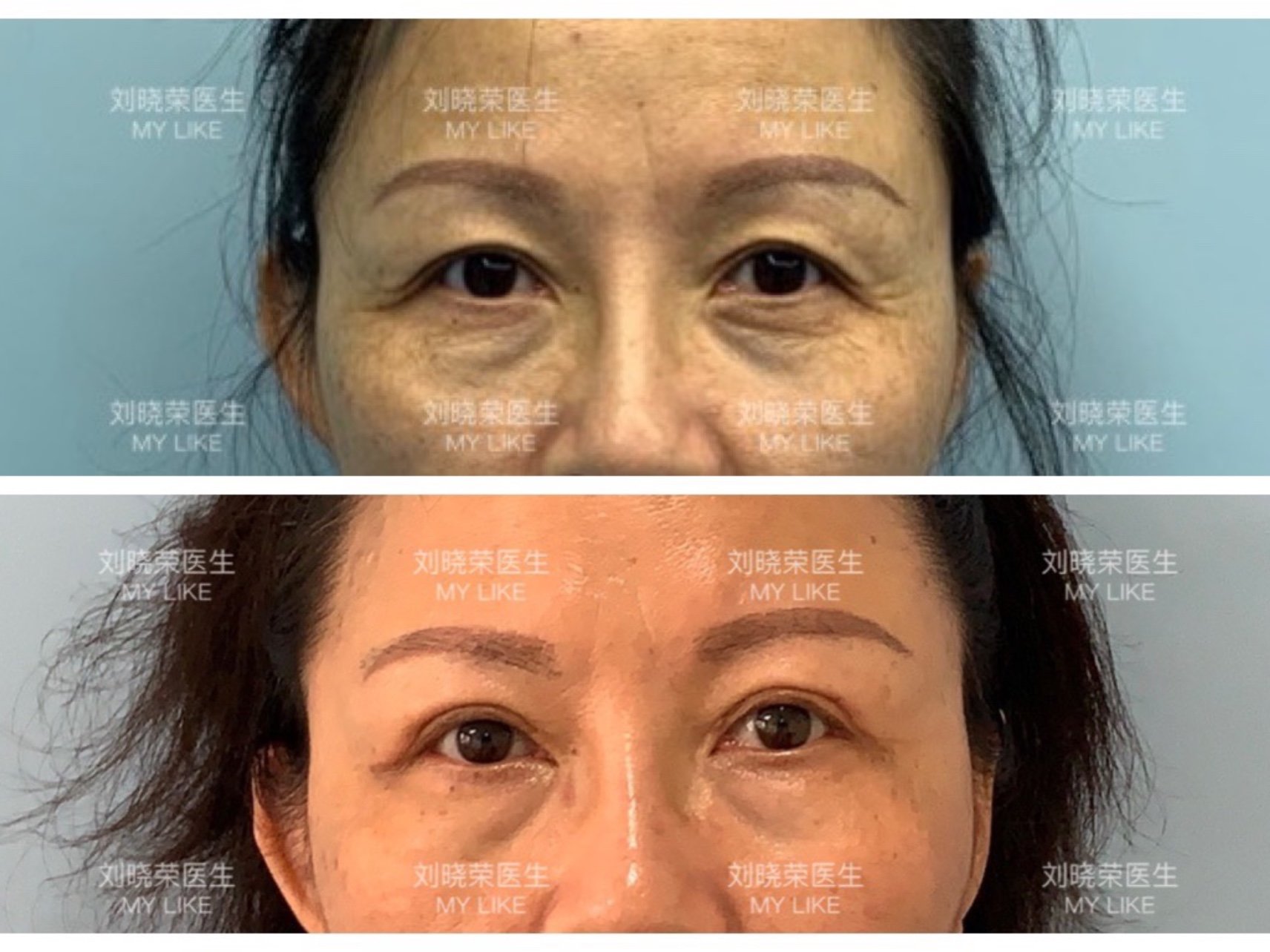 睑缘切口修复上睑松弛眼尾下垂术后半年