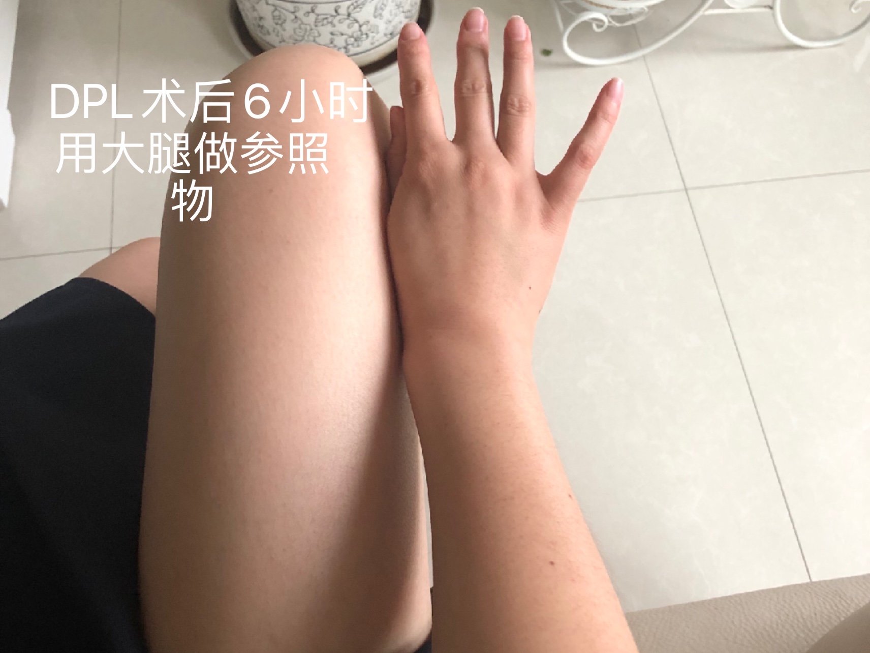 【dpl美肤】dpl黑金超光子 夏日【全身美白】大腿/小腿/腹部/手臂