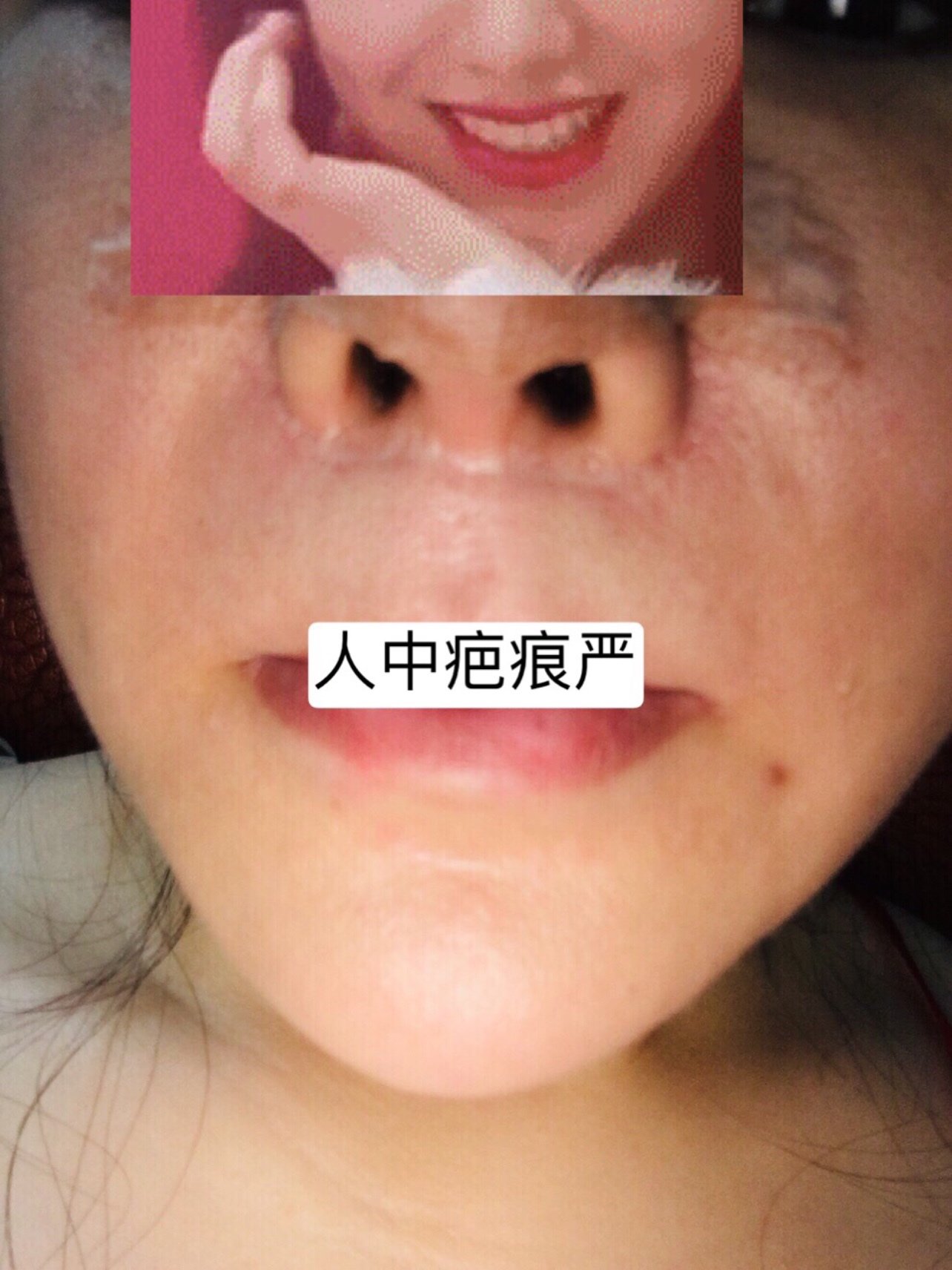 【人中缩短术】人中过长老态/人中加深/精雕隐痕/恢复